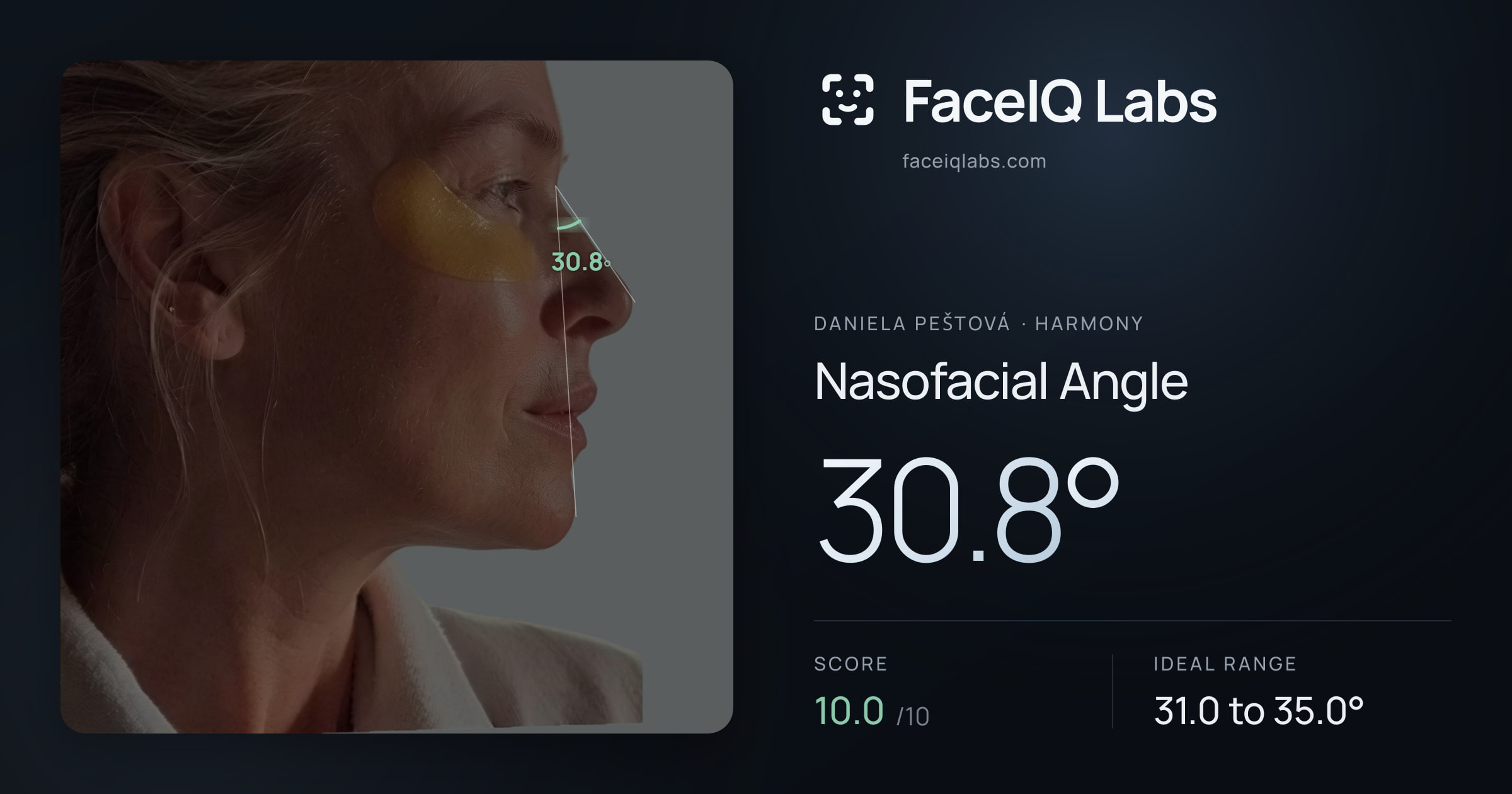 Daniela Peštová Nasofacial Angle: 30.8°, drawn on the photo