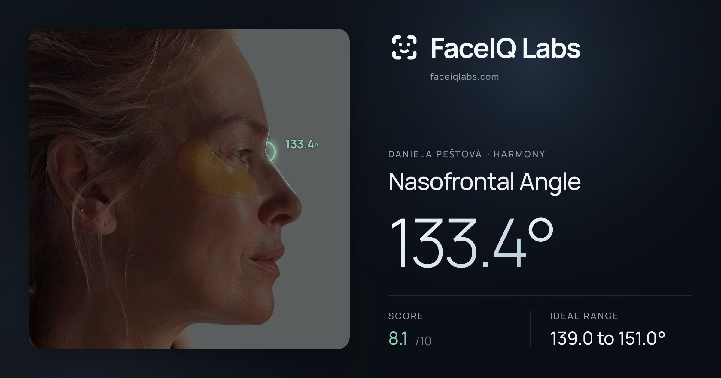 Daniela Peštová Nasofrontal Angle: 133.4°, drawn on the photo
