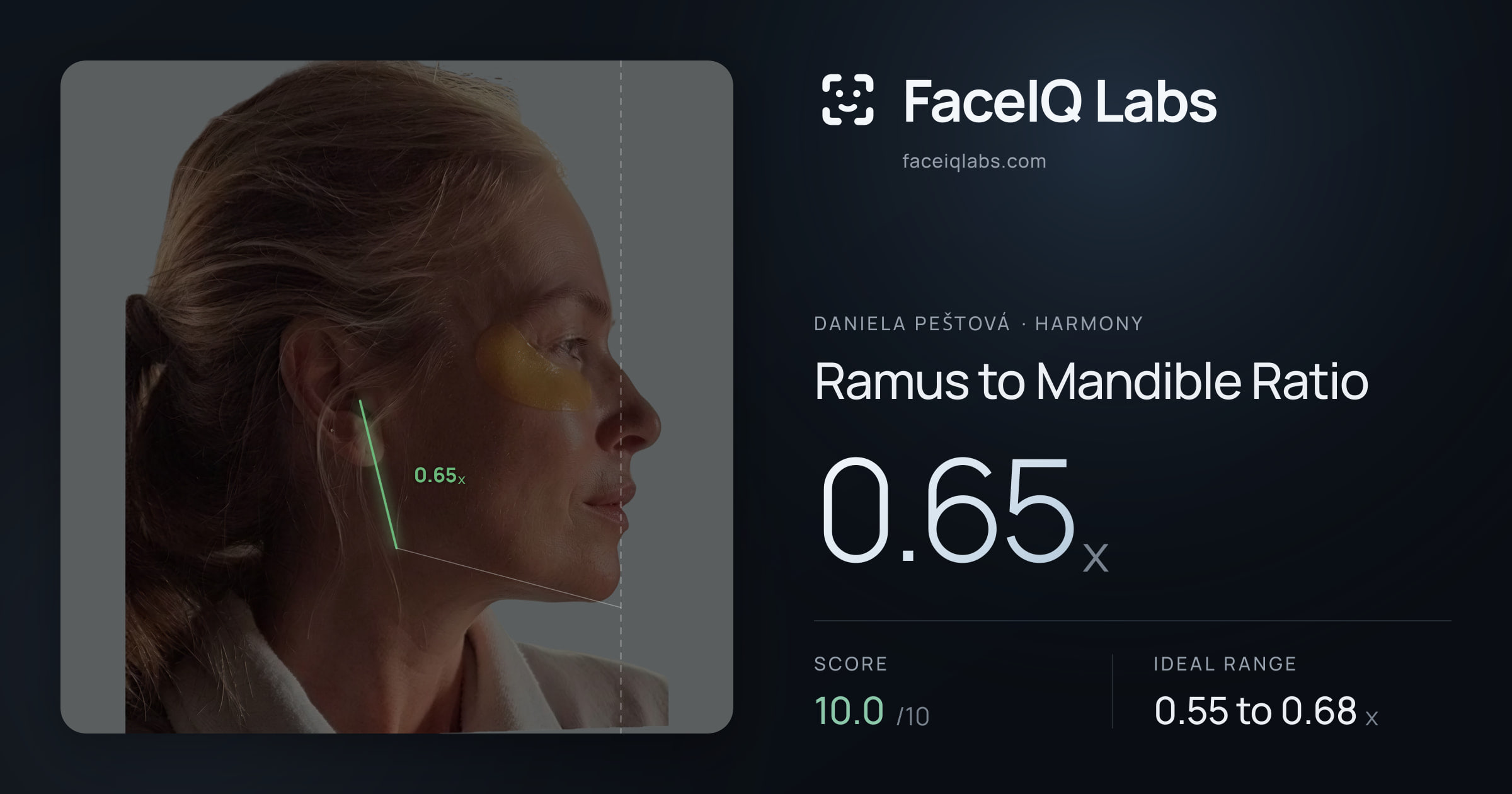 Daniela Peštová Ramus to Mandible Ratio: 0.65x, drawn on the photo