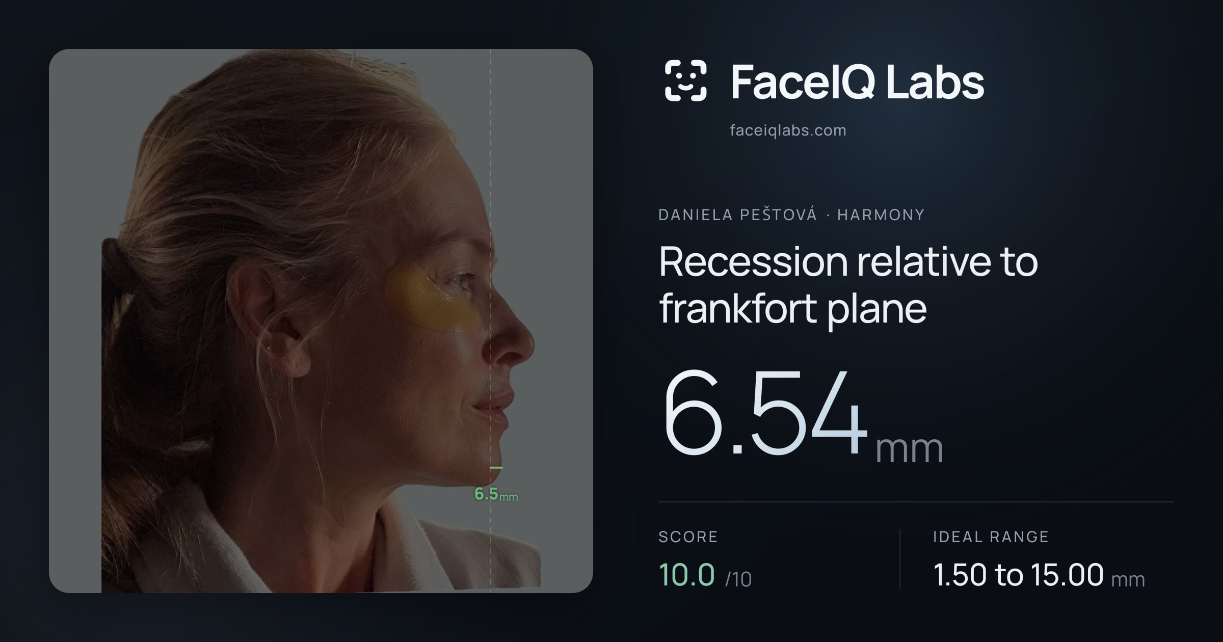 Daniela Peštová Recession relative to frankfort plane: 6.54mm, drawn on the photo