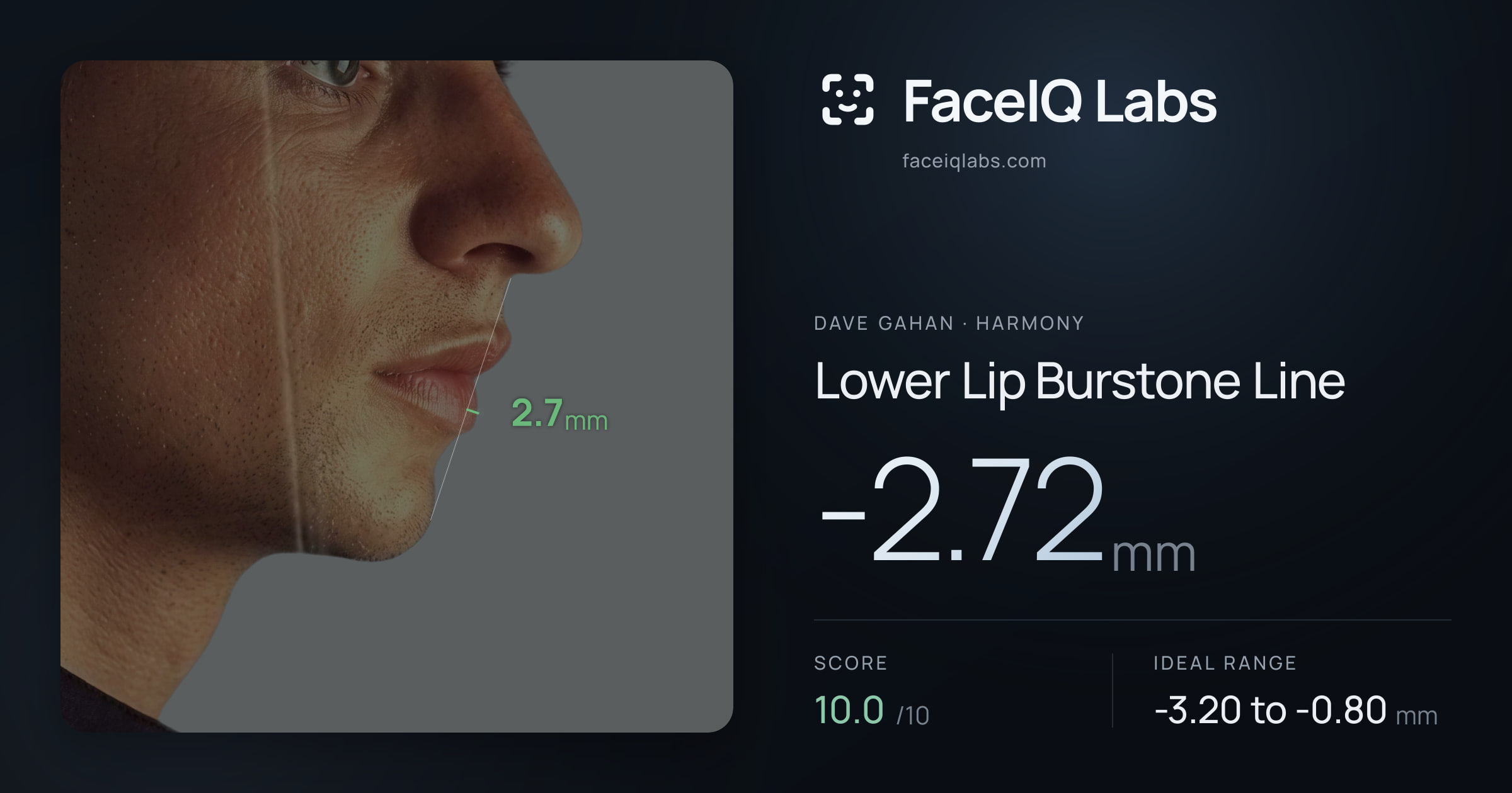 Dave Gahan Lower Lip Burstone Line: -2.72mm, drawn on the photo