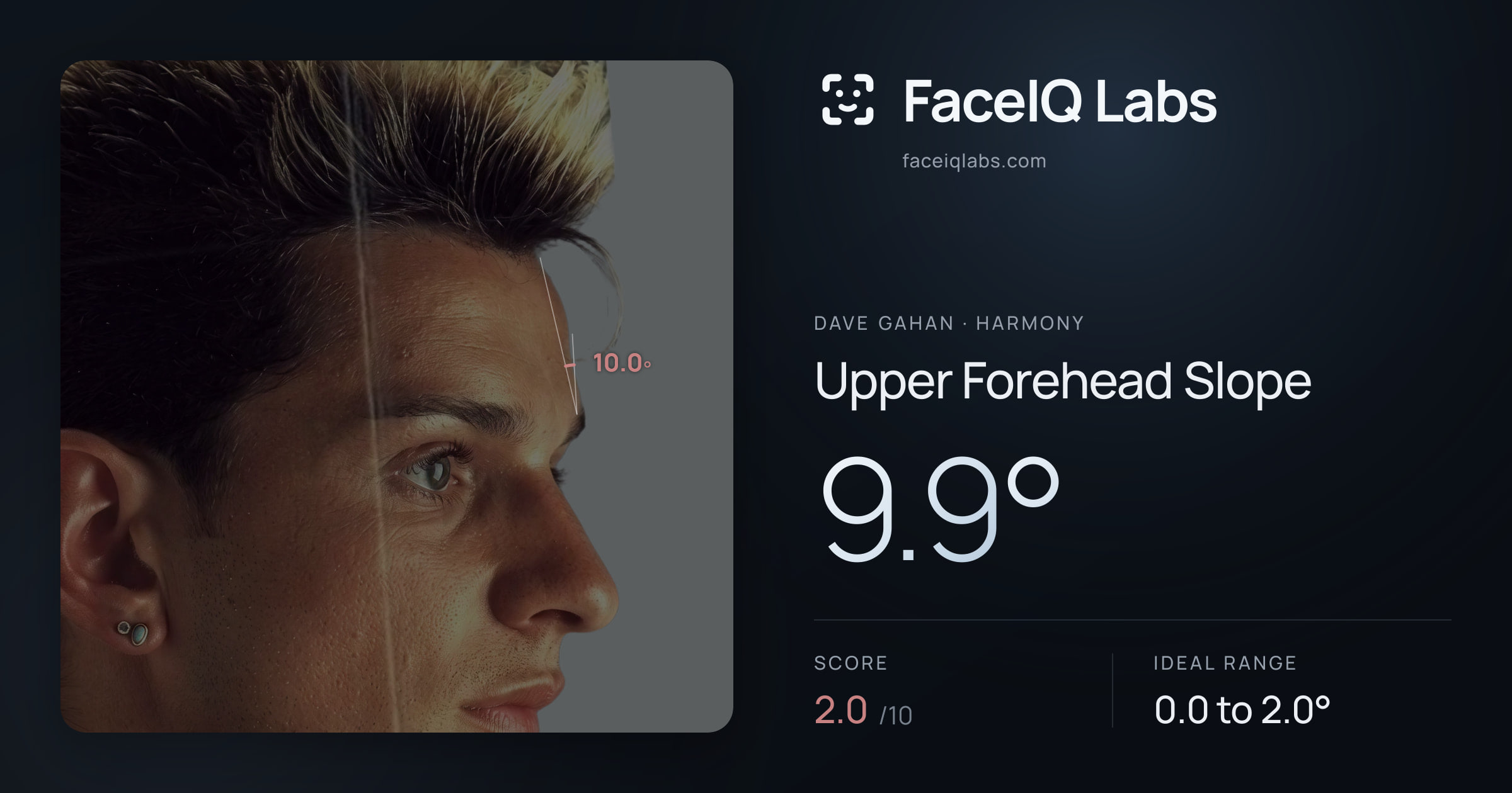 Dave Gahan Upper Forehead Slope: 9.9°, drawn on the photo