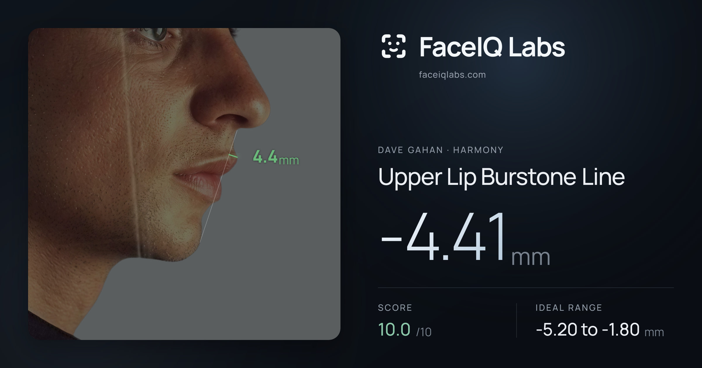 Dave Gahan Upper Lip Burstone Line: -4.41mm, drawn on the photo