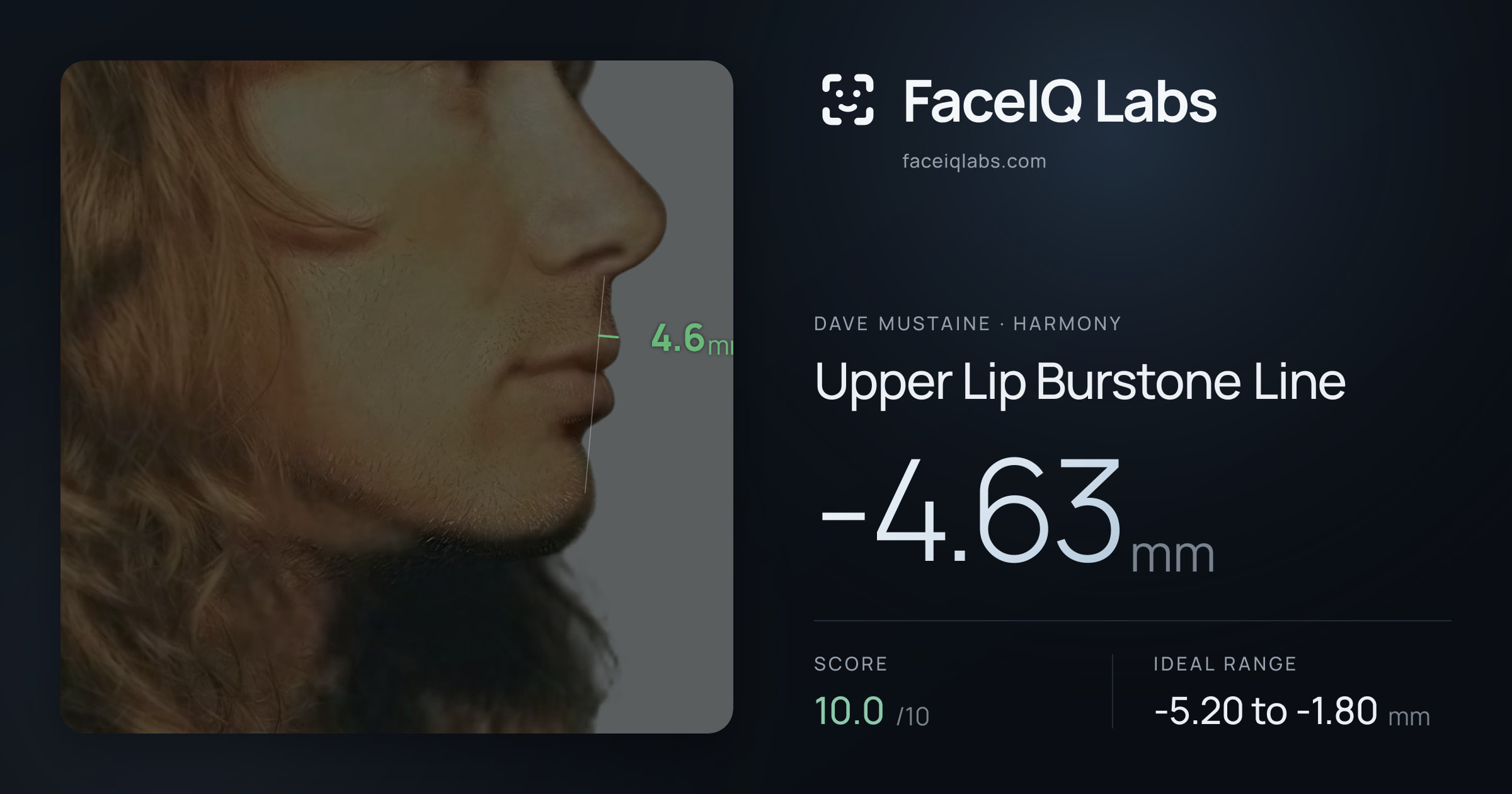 Dave Mustaine Upper Lip Burstone Line: -4.63mm, drawn on the photo