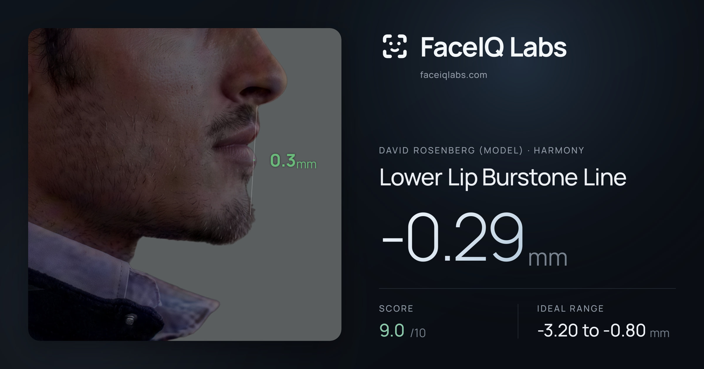 David Rosenberg (Model) Lower Lip Burstone Line: -0.29mm, drawn on the photo