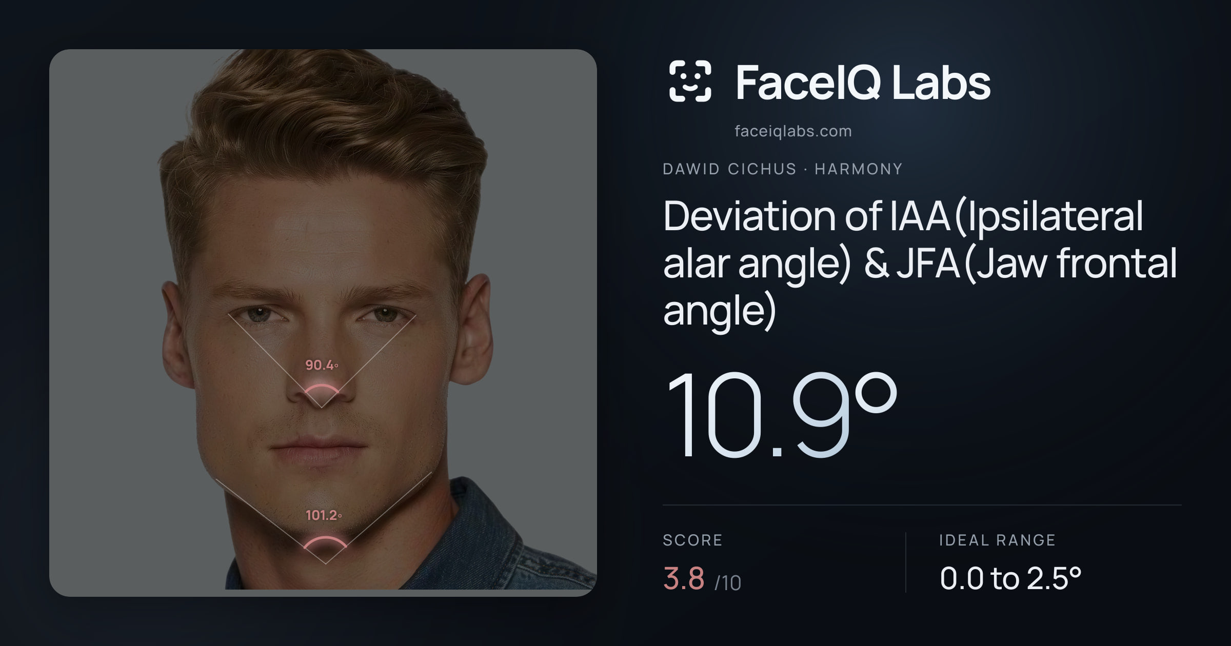 Dawid Cichus Deviation of IAA(Ipsilateral alar angle) & JFA(Jaw frontal angle): 10.9°, drawn on the photo