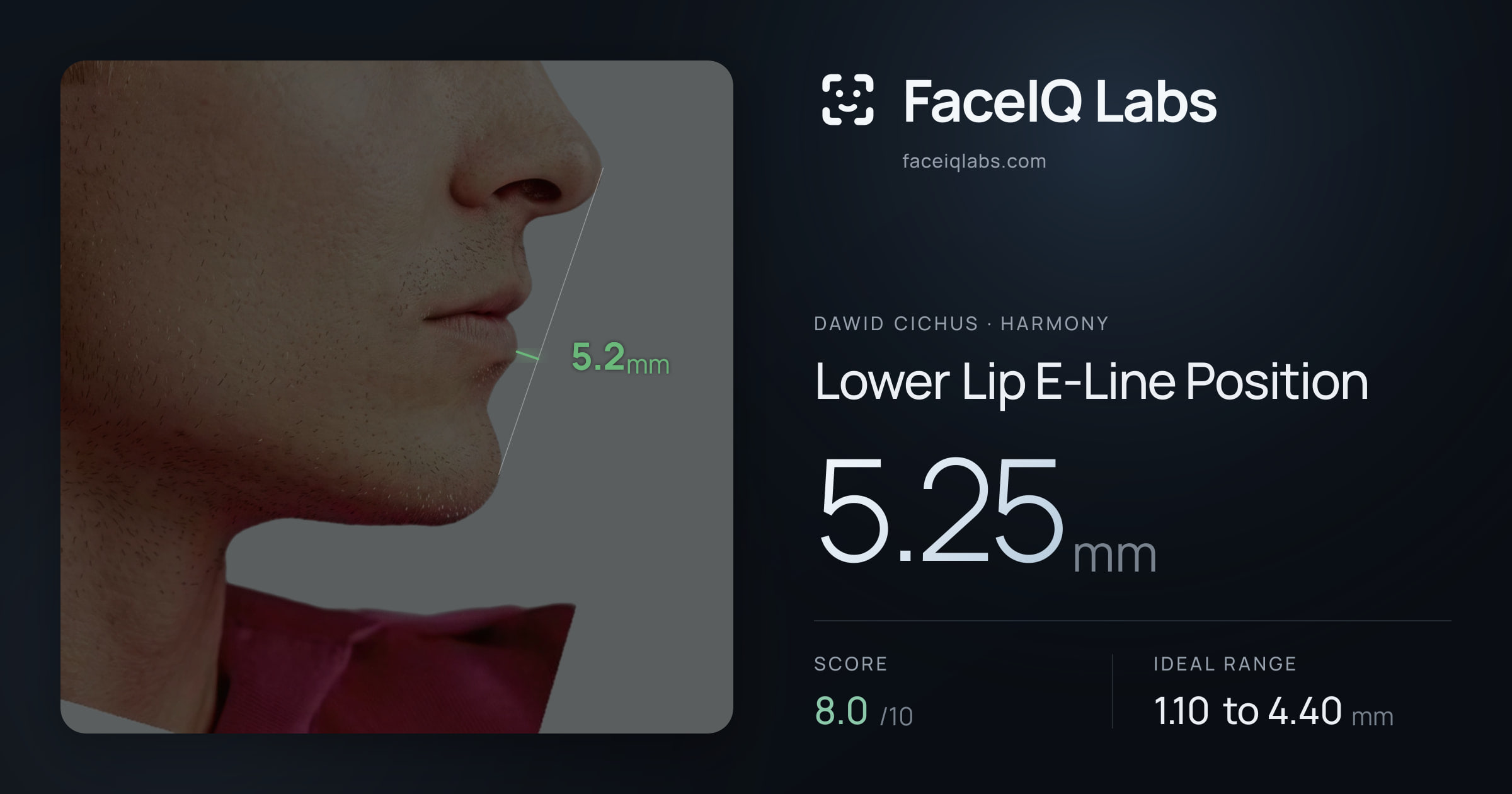 Dawid Cichus Lower Lip E-Line Position: 5.25mm, drawn on the photo
