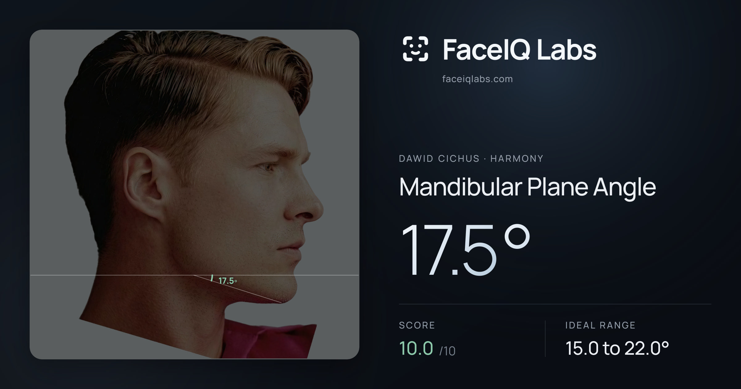 Dawid Cichus Mandibular Plane Angle: 17.5°, drawn on the photo