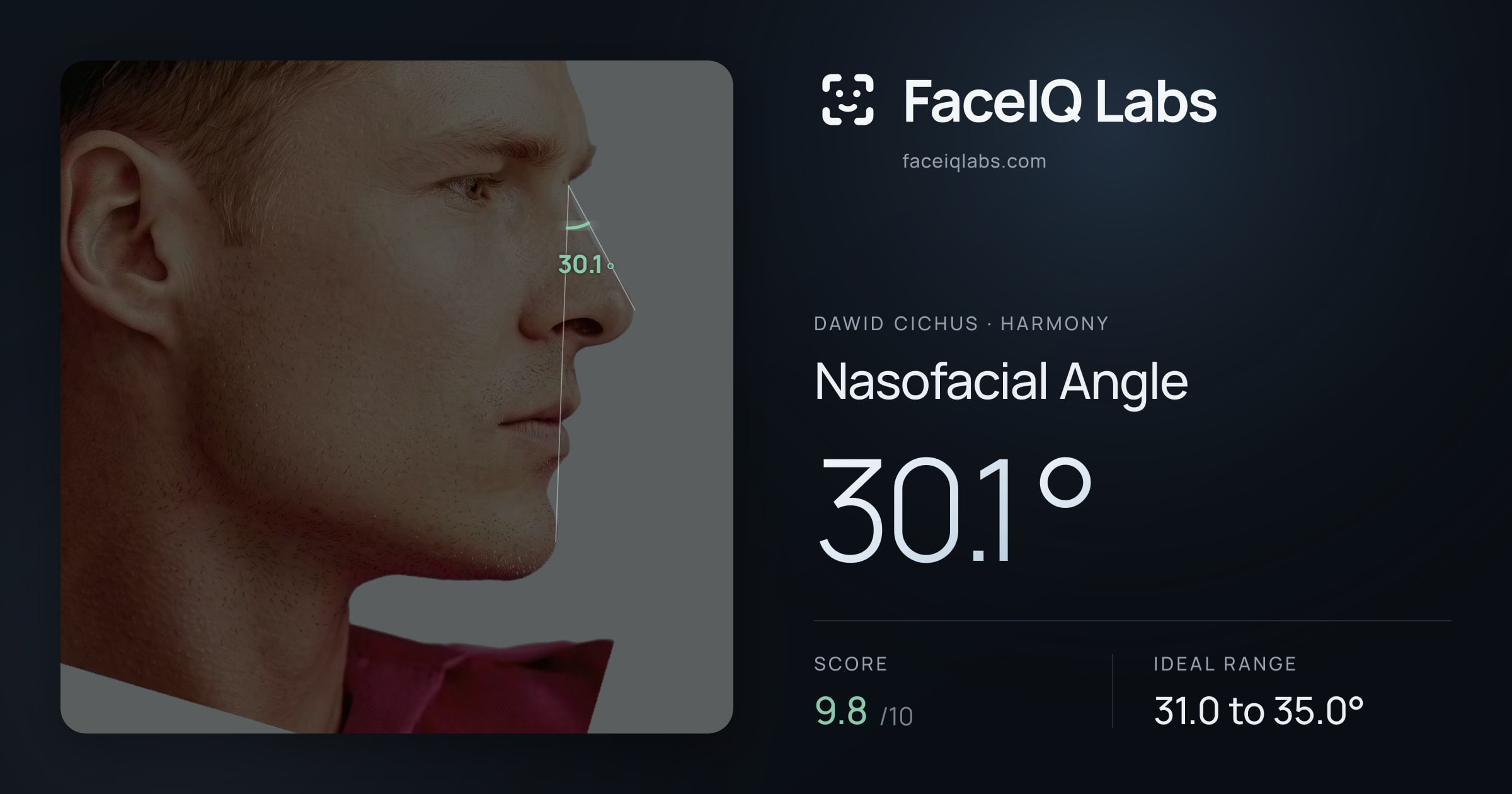 Dawid Cichus Nasofacial Angle: 30.1°, drawn on the photo