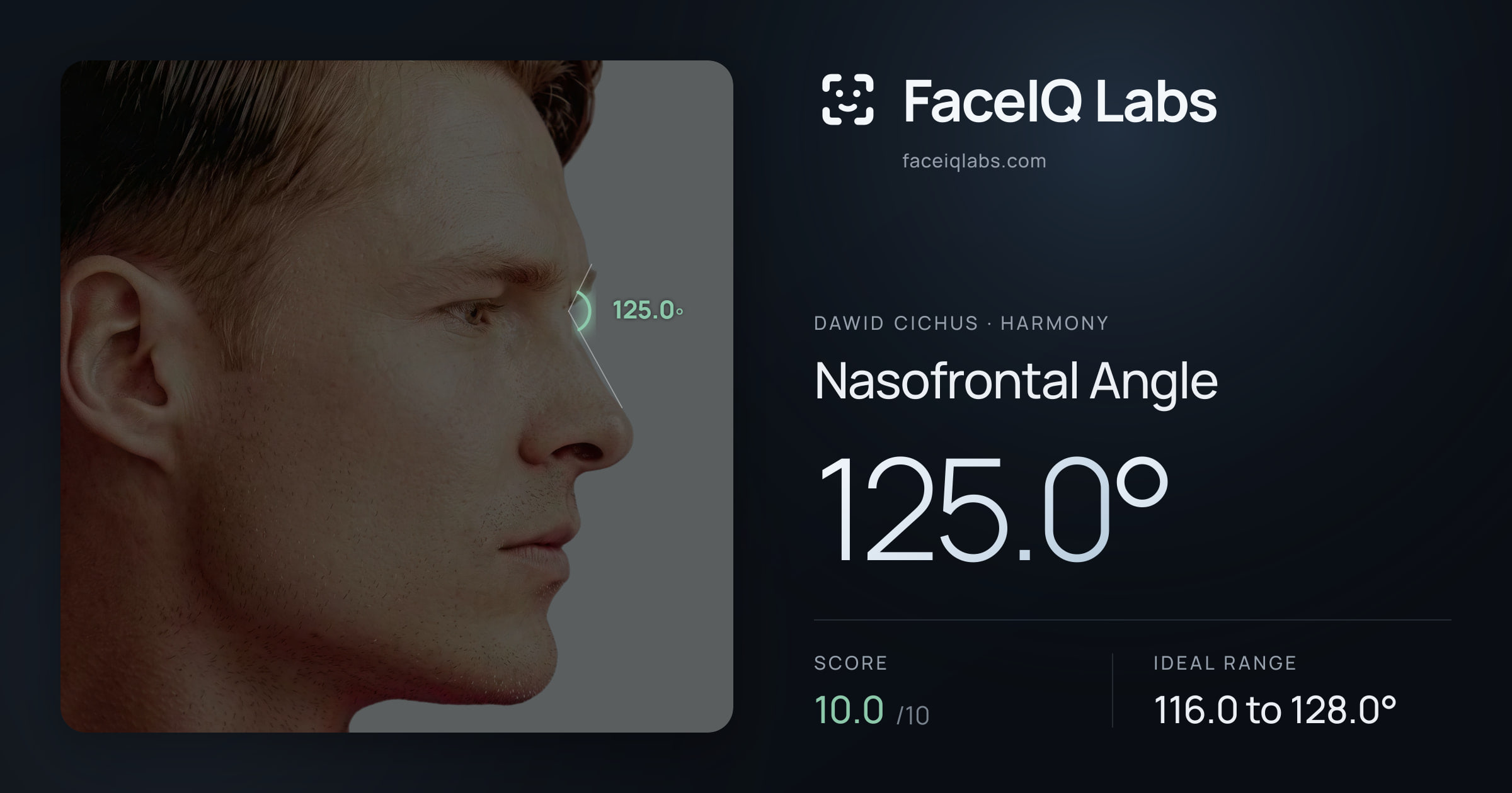 Dawid Cichus Nasofrontal Angle: 125.0°, drawn on the photo