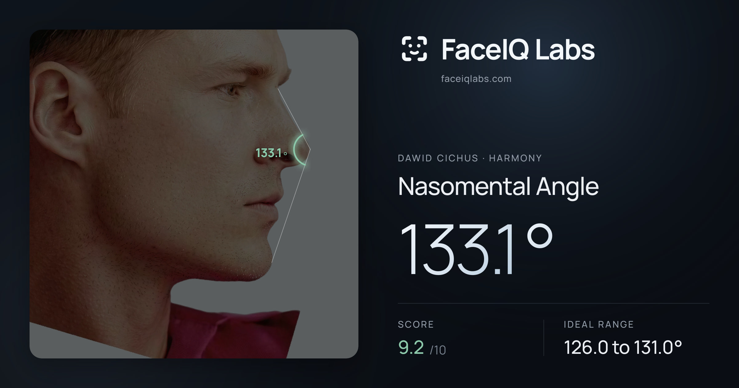 Dawid Cichus Nasomental Angle: 133.1°, drawn on the photo