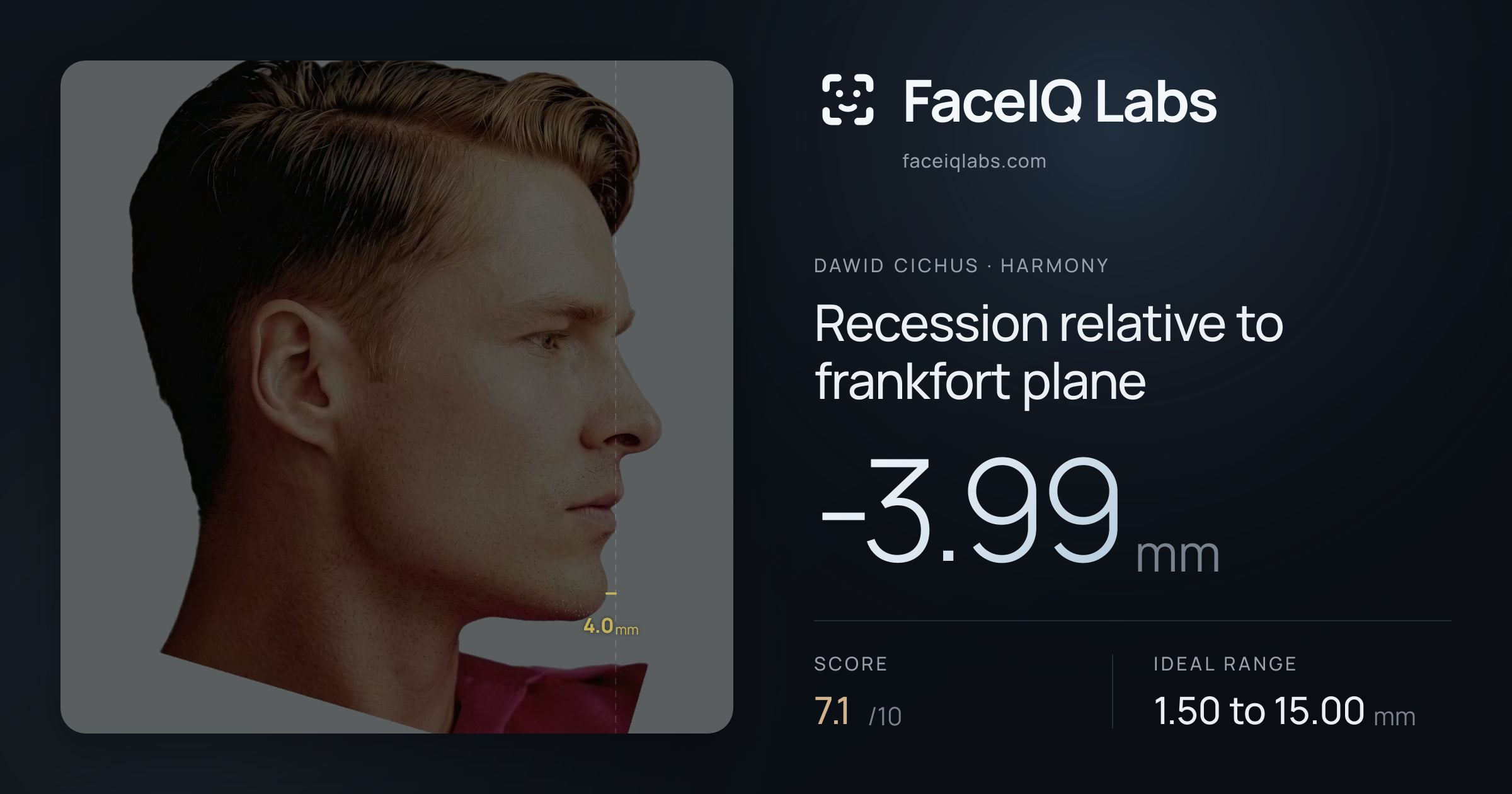 Dawid Cichus Recession relative to frankfort plane: -3.99mm, drawn on the photo