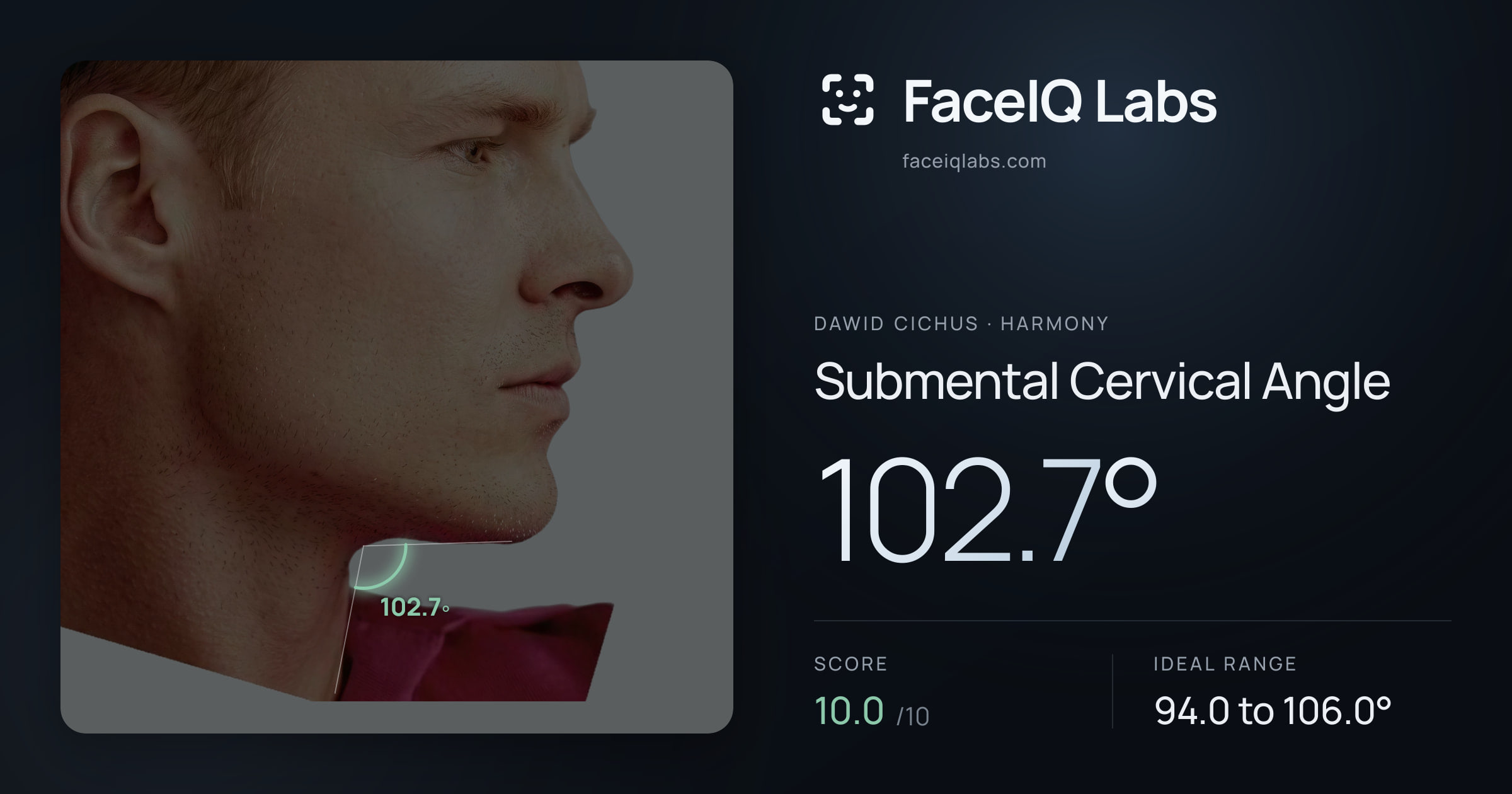 Dawid Cichus Submental Cervical Angle: 102.7°, drawn on the photo