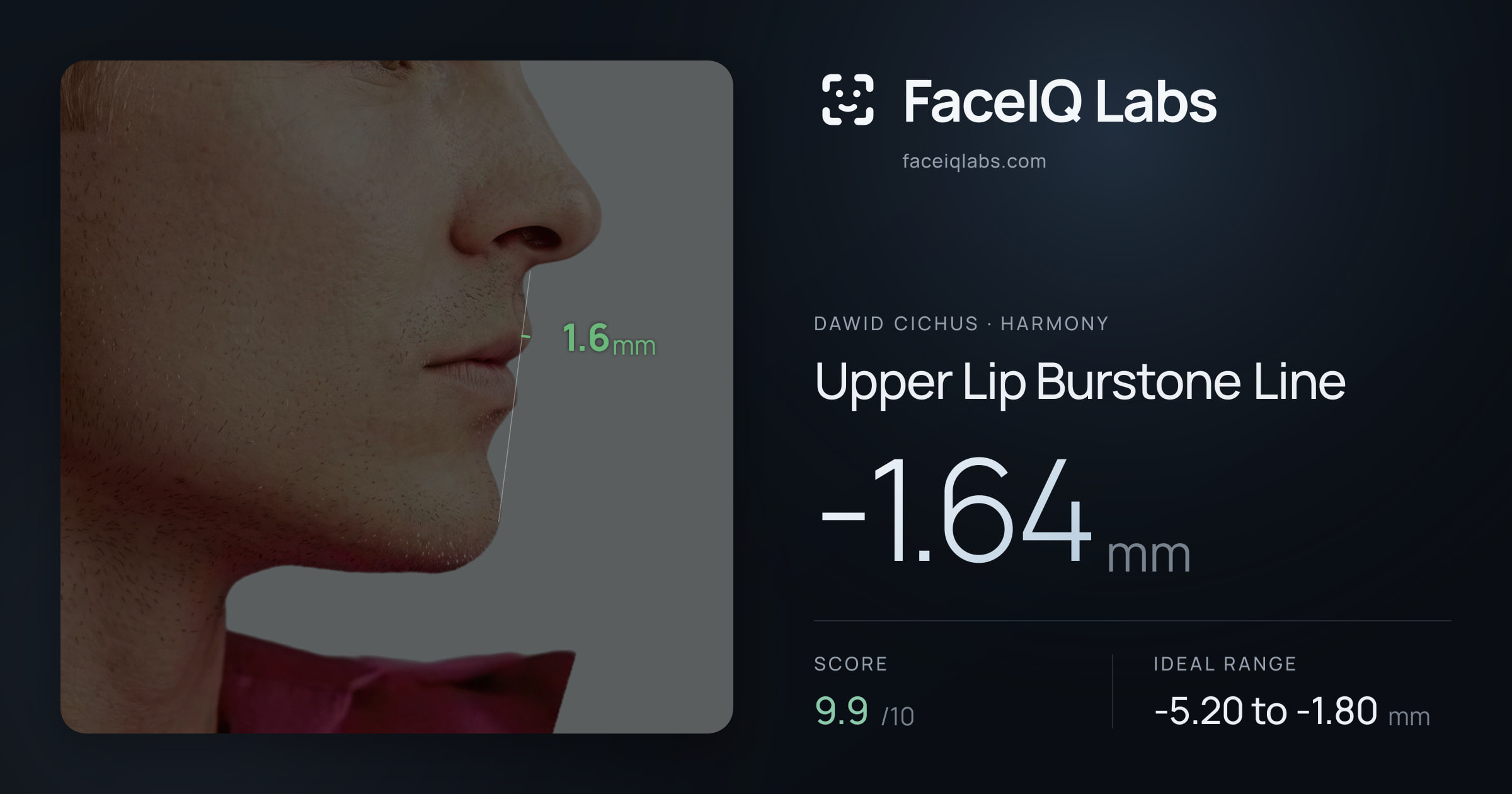 Dawid Cichus Upper Lip Burstone Line: -1.64mm, drawn on the photo