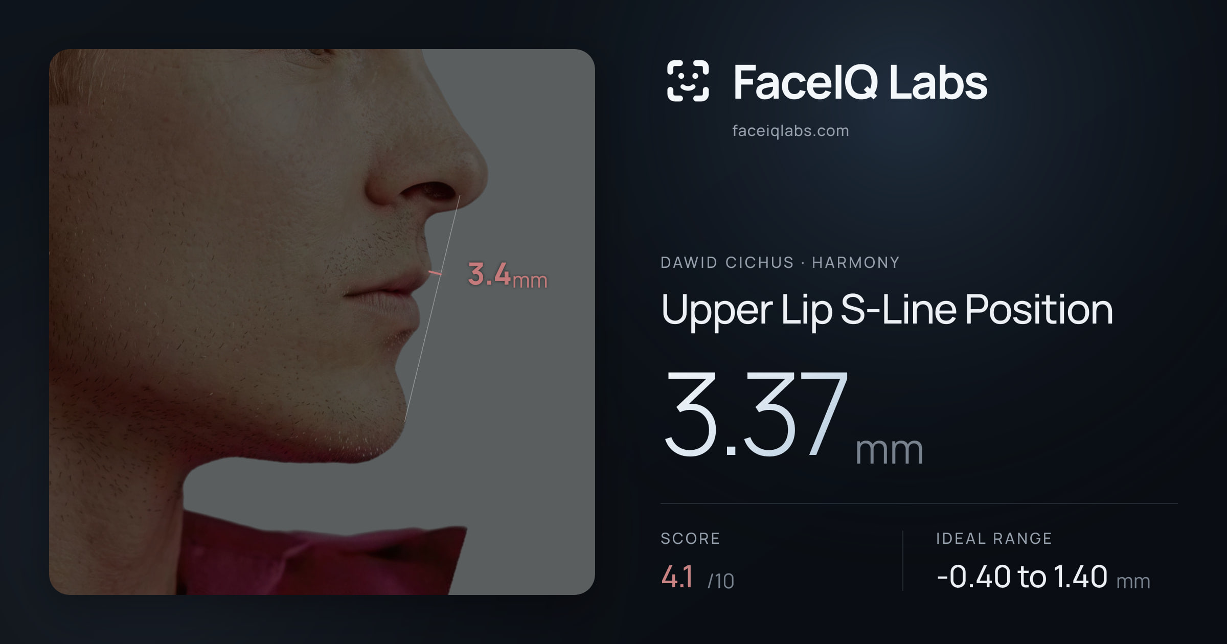 Dawid Cichus Upper Lip S-Line Position: 3.37mm, drawn on the photo