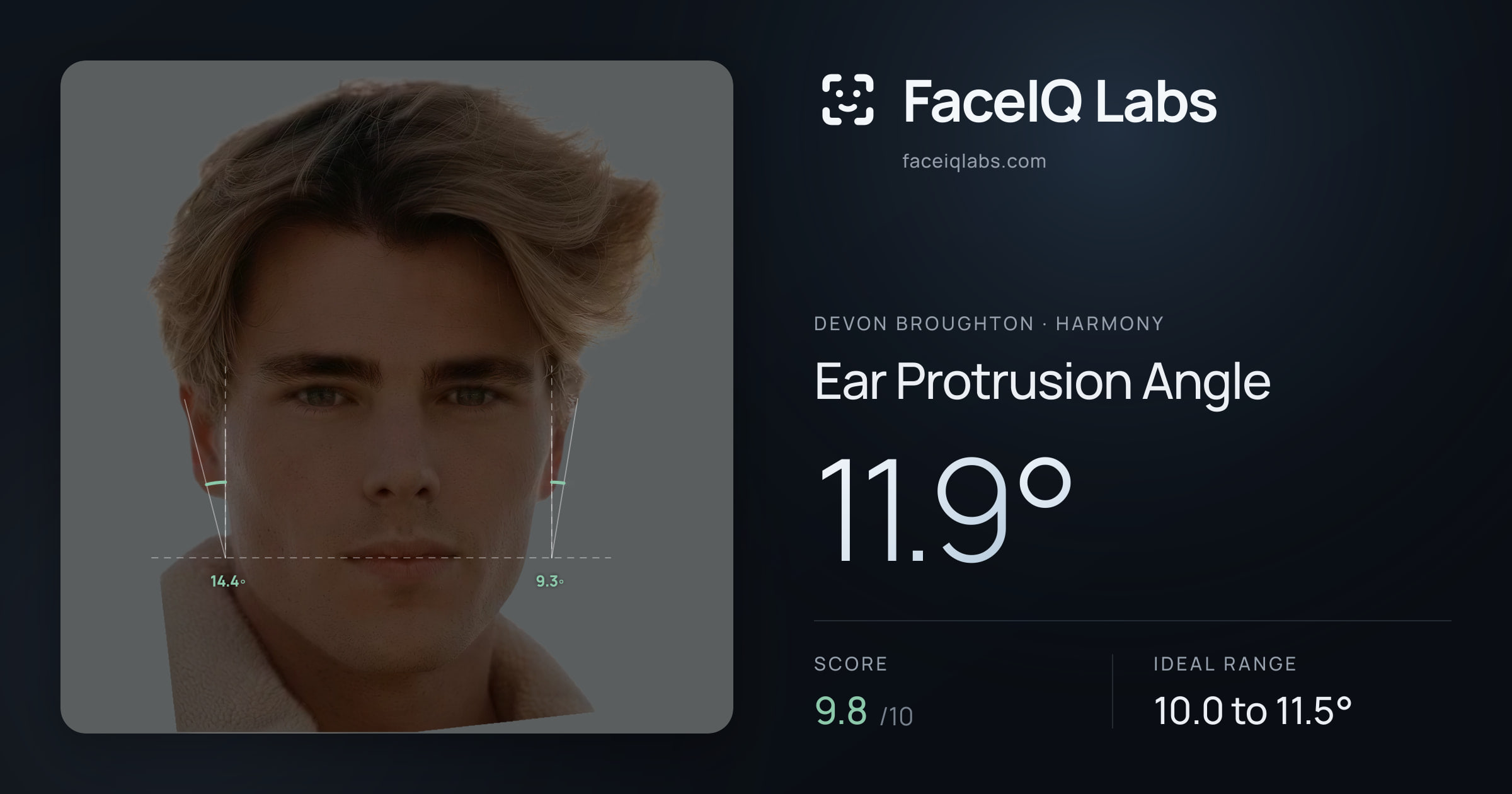 Devon Broughton Ear Protrusion Angle: 11.9°, drawn on the photo