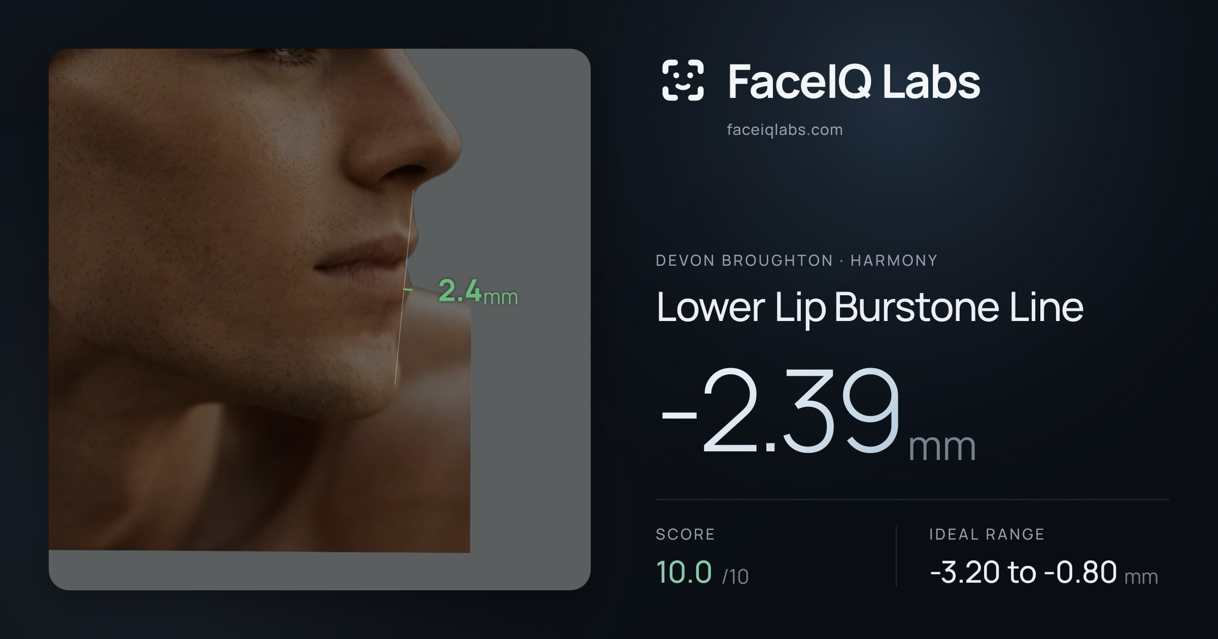 Devon Broughton Lower Lip Burstone Line: -2.39mm, drawn on the photo