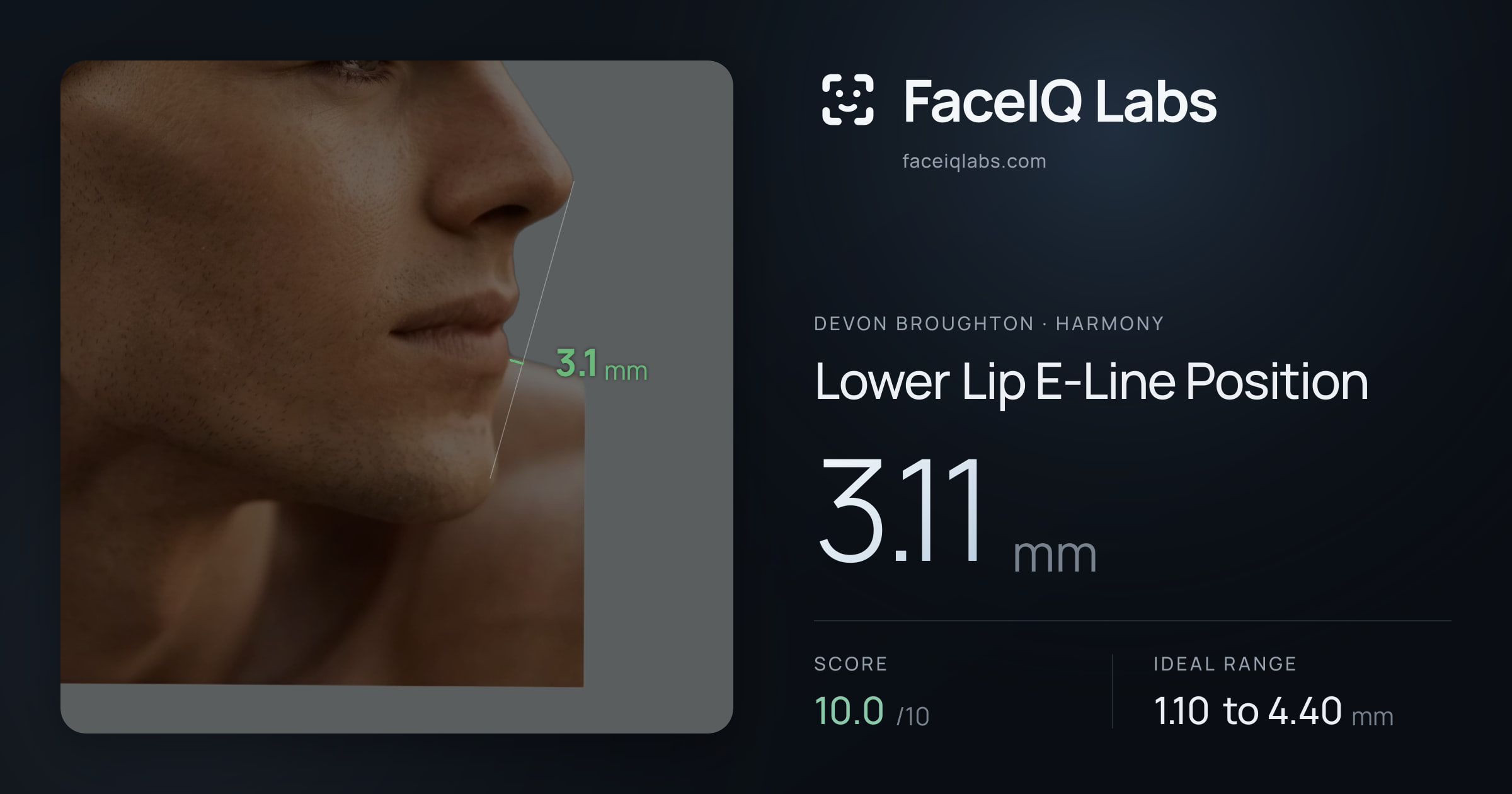 Devon Broughton Lower Lip E-Line Position: 3.11mm, drawn on the photo
