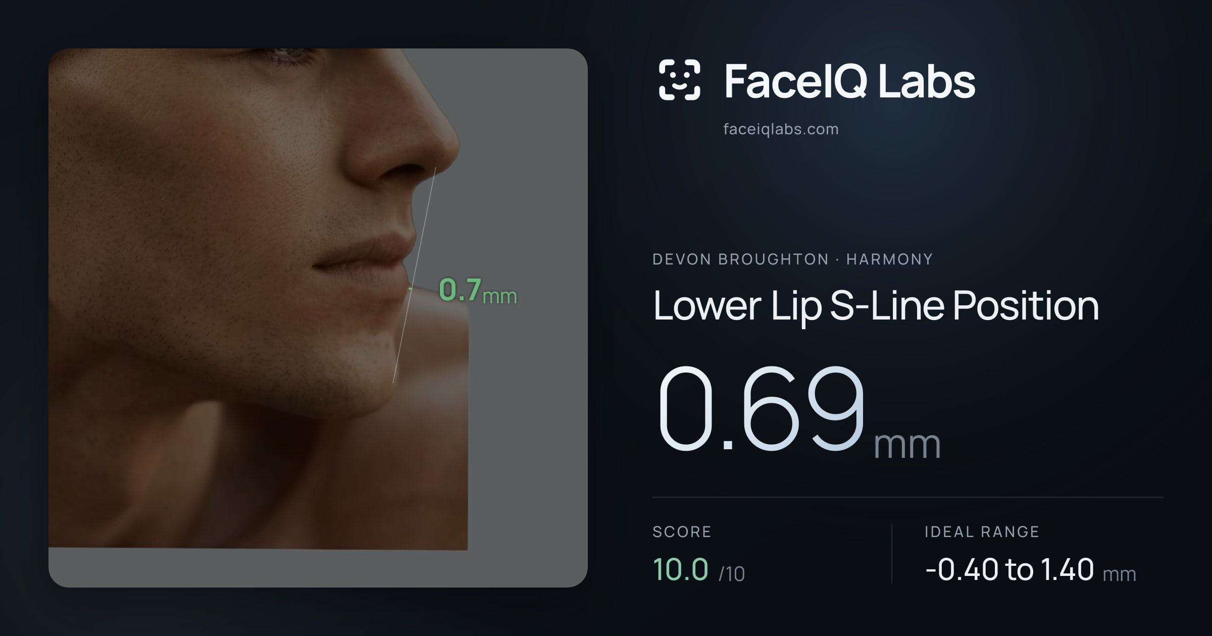 Devon Broughton Lower Lip S-Line Position: 0.69mm, drawn on the photo