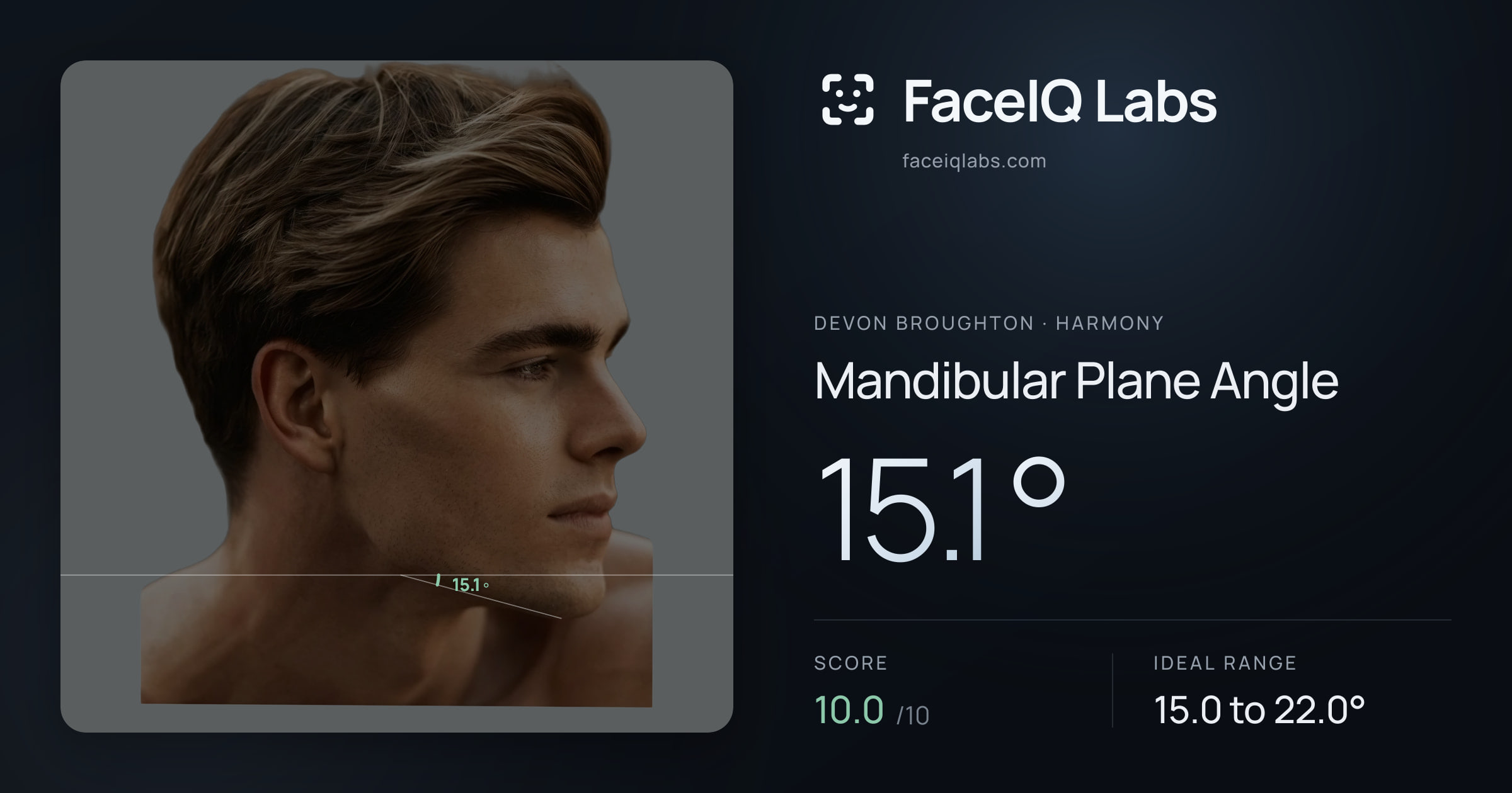 Devon Broughton Mandibular Plane Angle: 15.1°, drawn on the photo