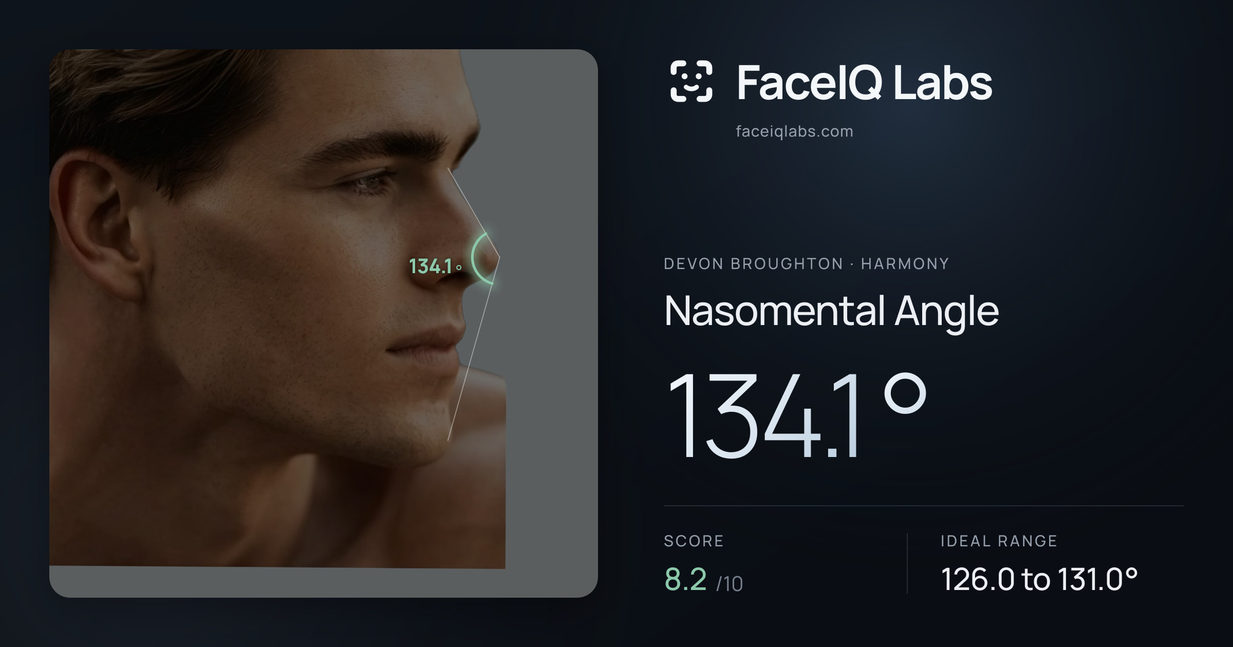 Devon Broughton Nasomental Angle: 134.1°, drawn on the photo