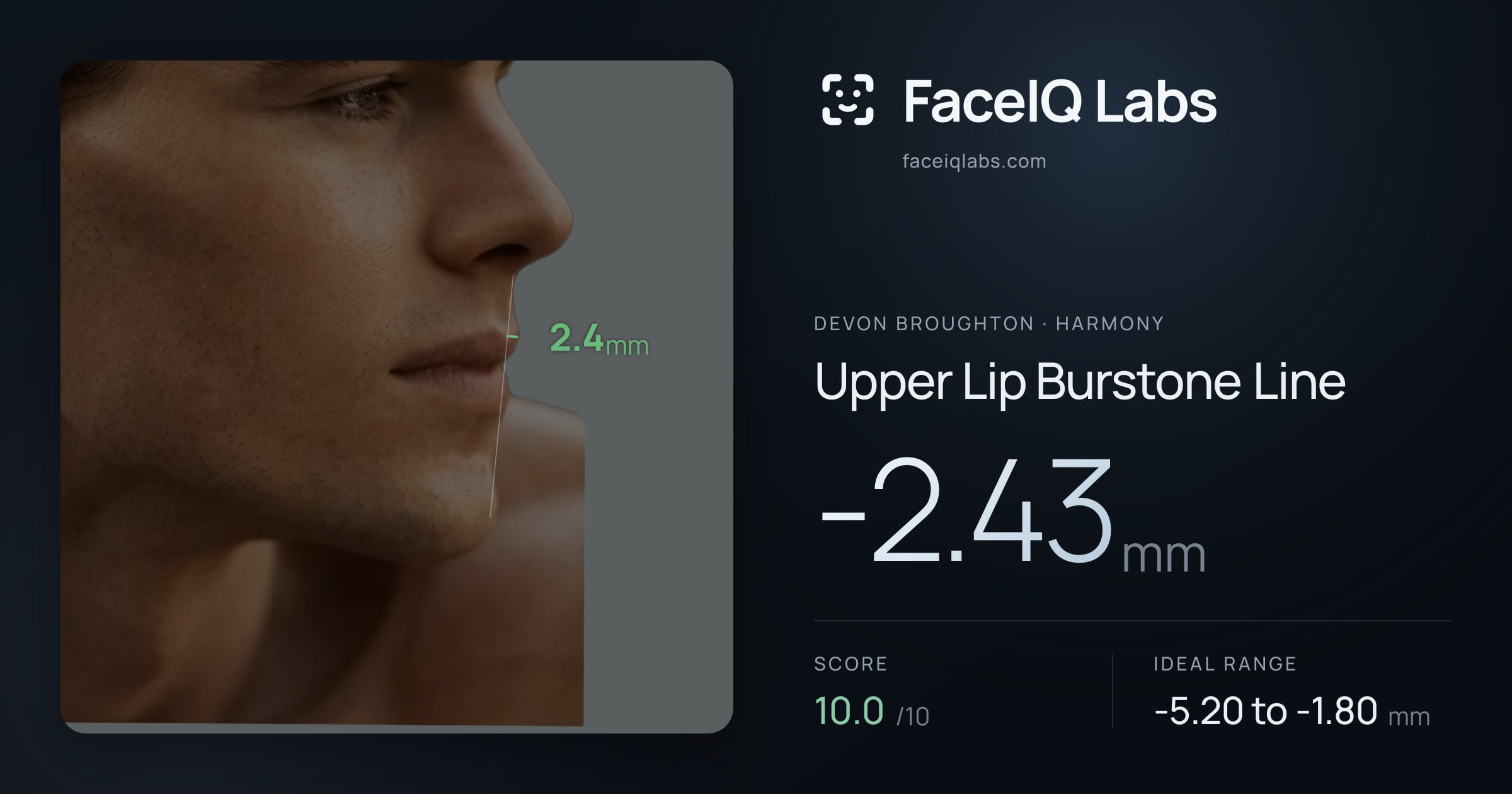 Devon Broughton Upper Lip Burstone Line: -2.43mm, drawn on the photo