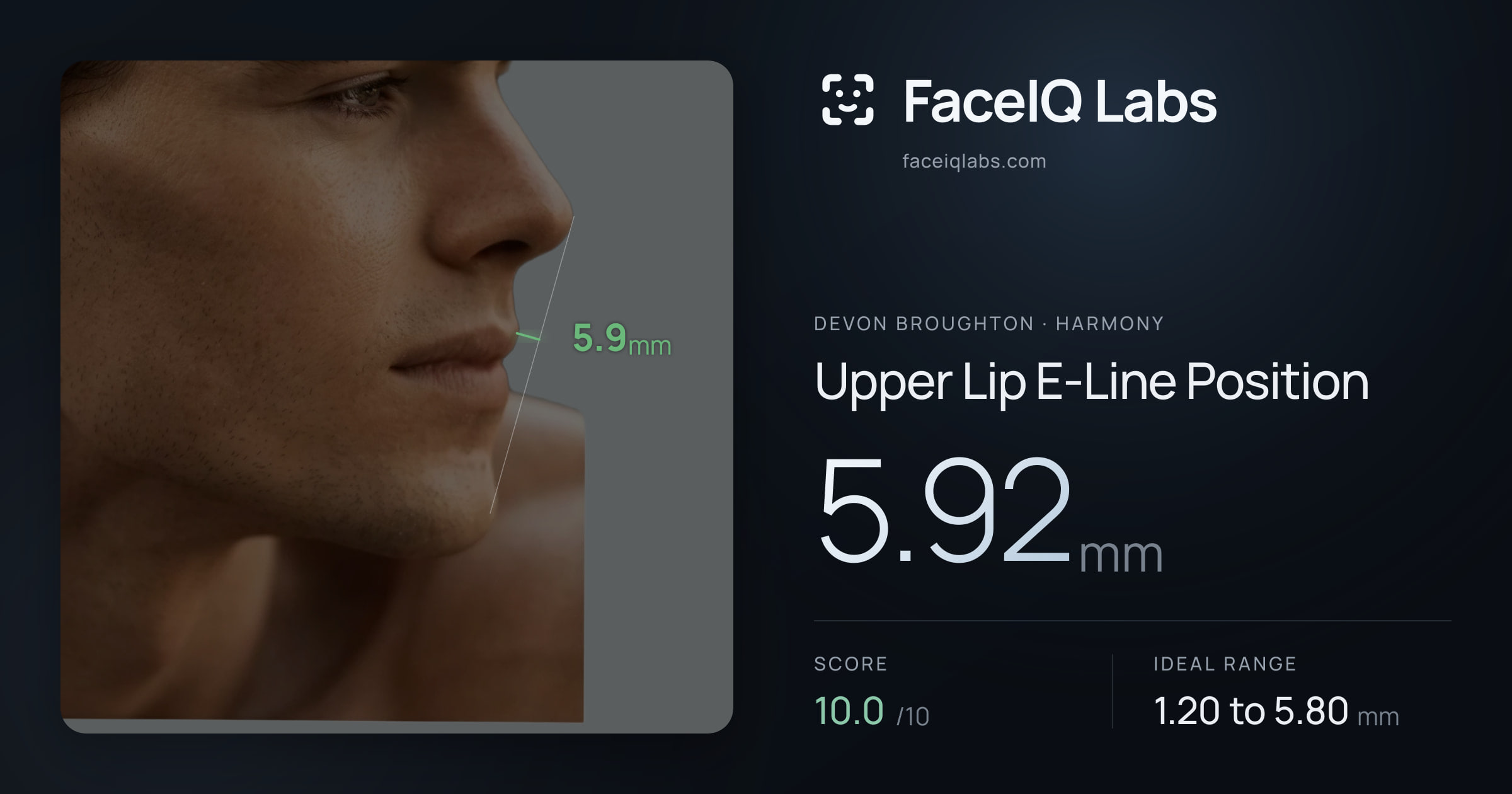 Devon Broughton Upper Lip E-Line Position: 5.92mm, drawn on the photo
