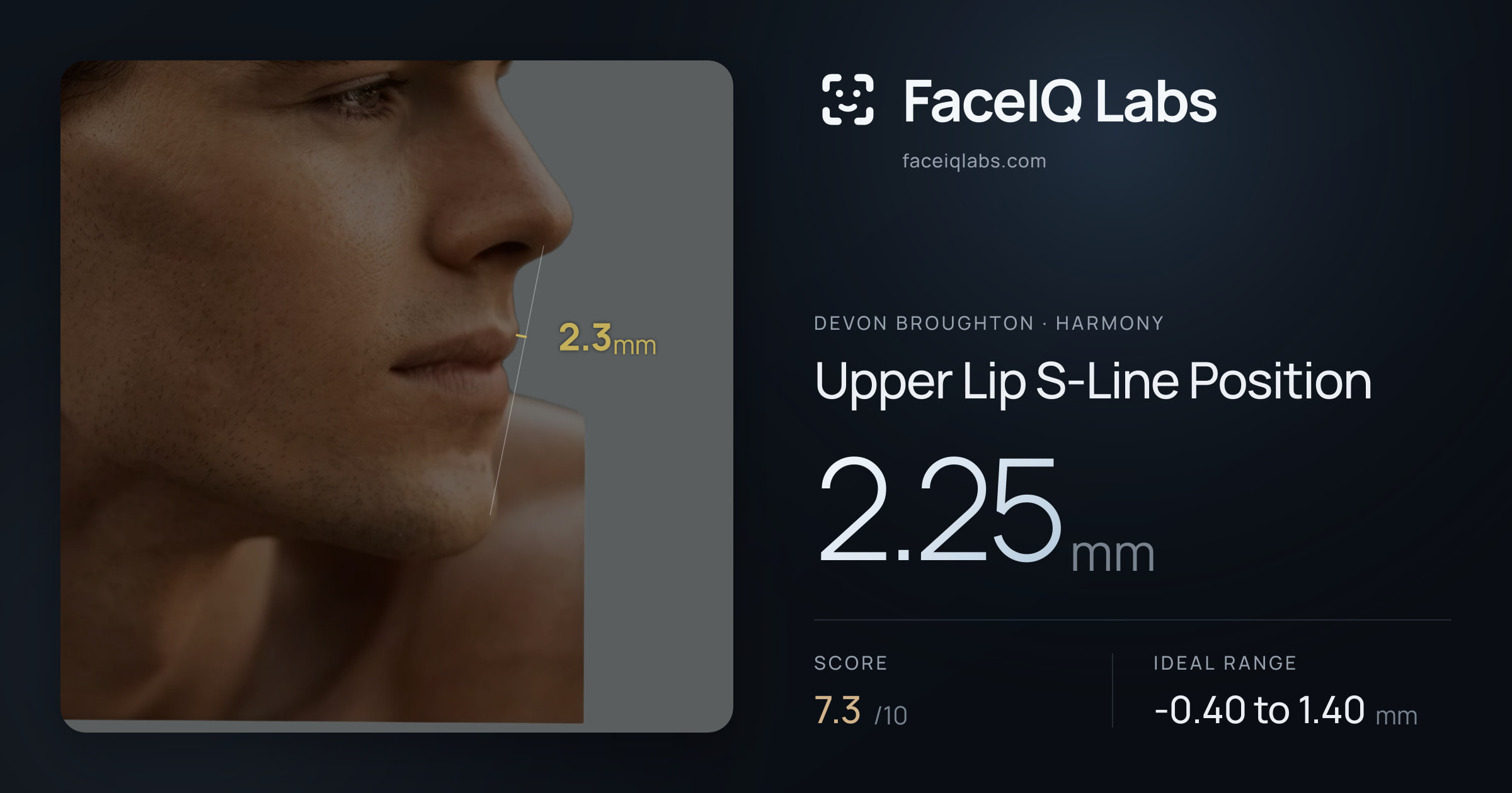 Devon Broughton Upper Lip S-Line Position: 2.25mm, drawn on the photo