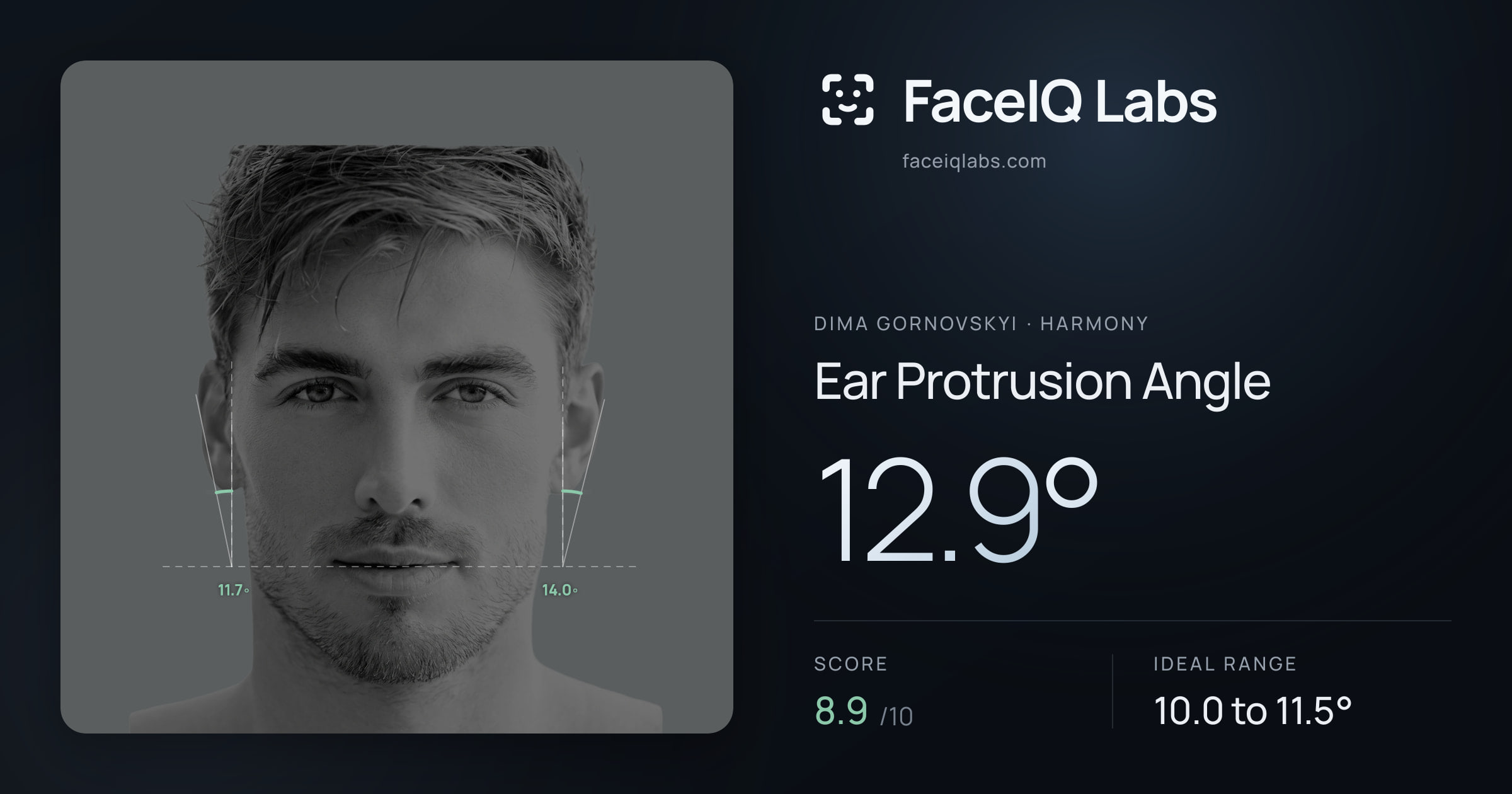Dima Gornovskyi Ear Protrusion Angle: 12.9°, drawn on the photo