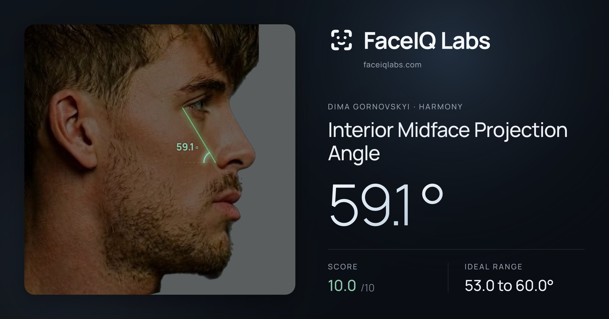 Dima Gornovskyi Interior Midface Projection Angle: 59.1°, drawn on the photo