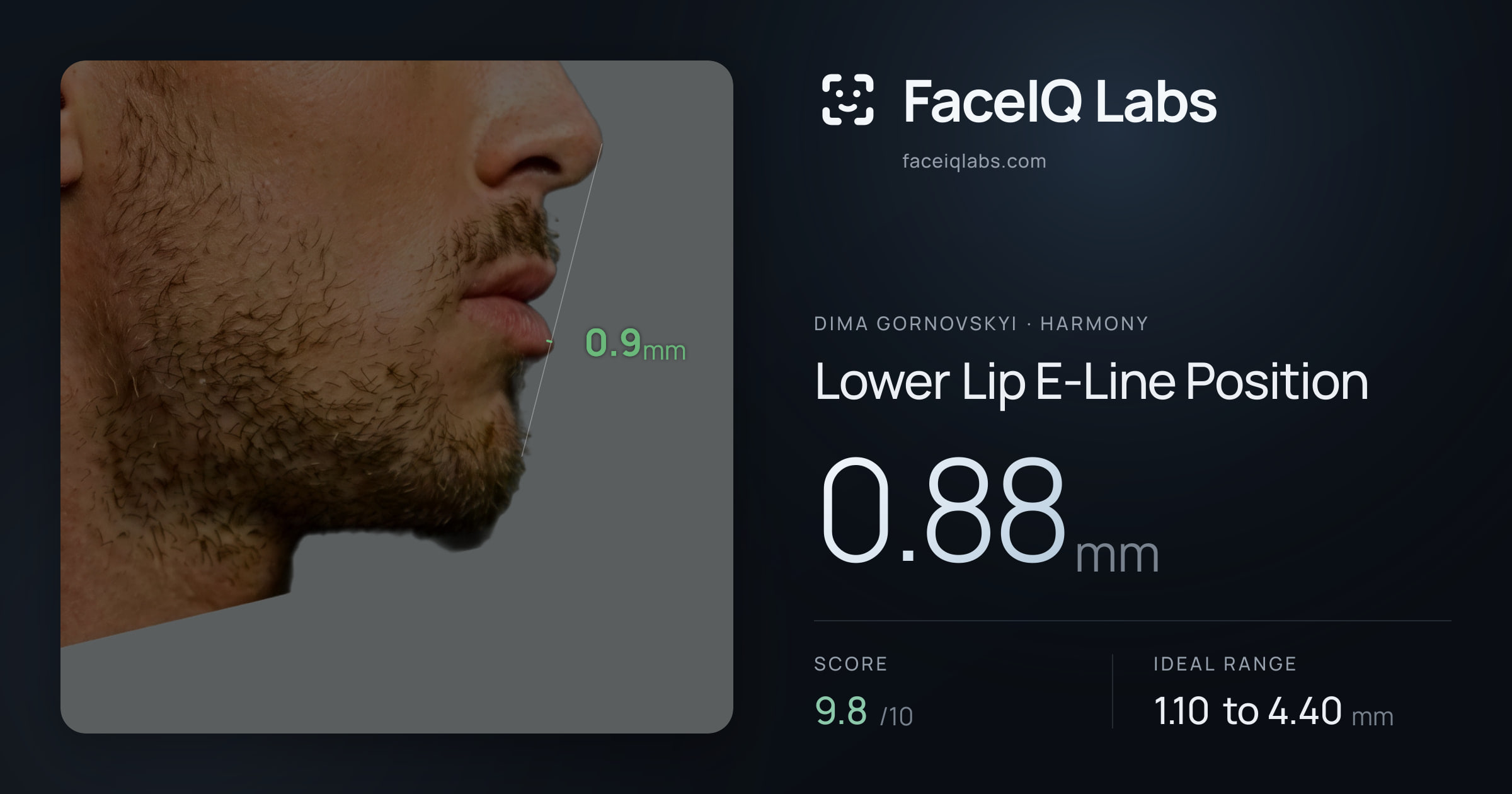 Dima Gornovskyi Lower Lip E-Line Position: 0.88mm, drawn on the photo