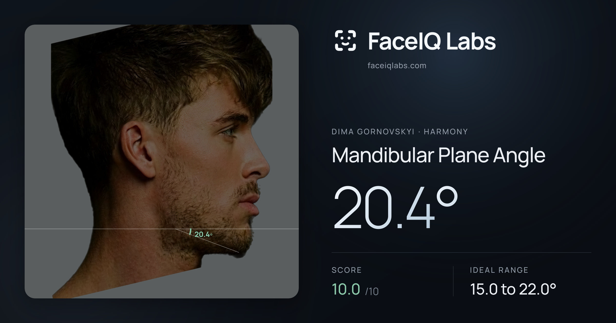 Dima Gornovskyi Mandibular Plane Angle: 20.4°, drawn on the photo