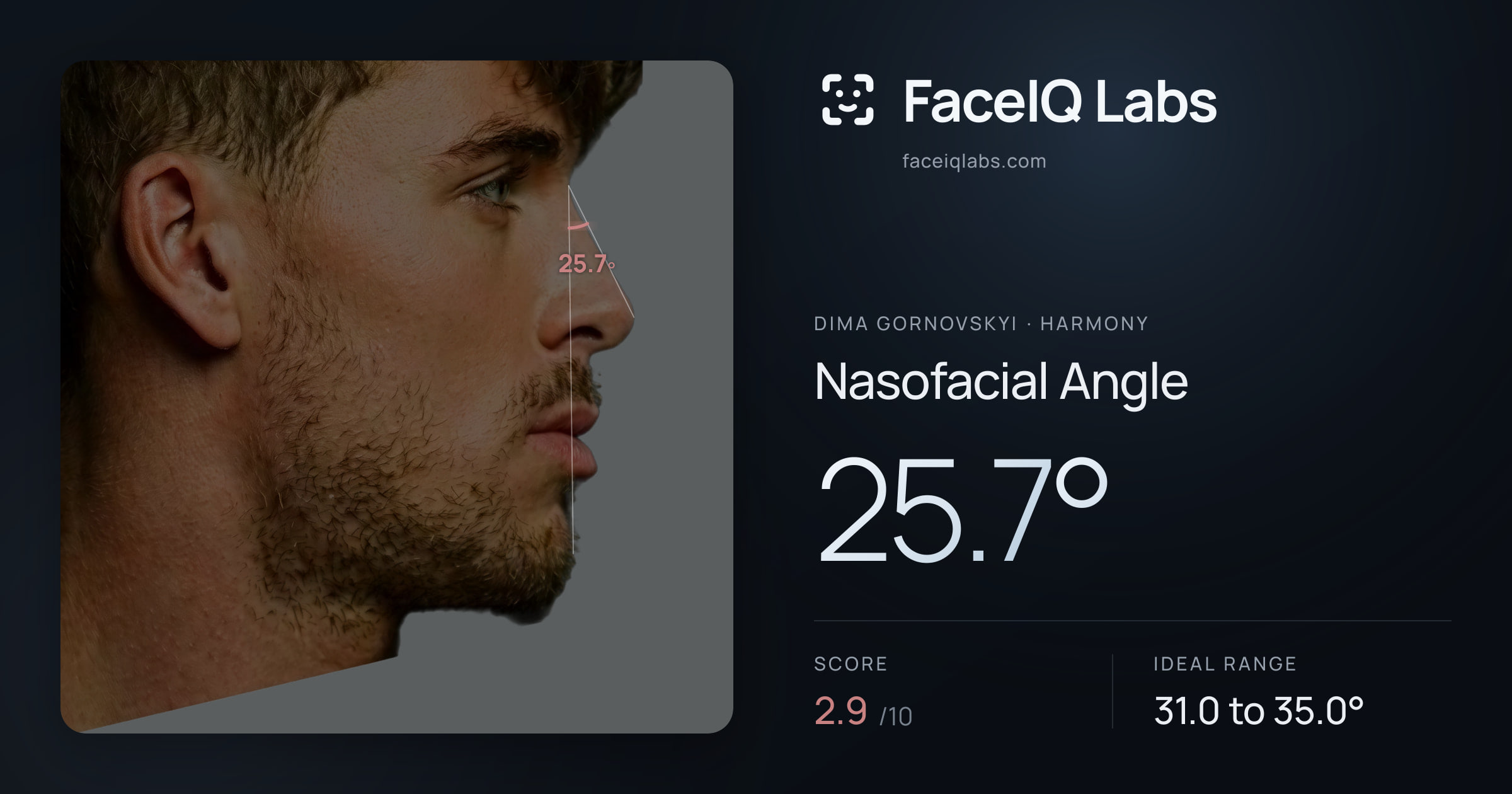 Dima Gornovskyi Nasofacial Angle: 25.7°, drawn on the photo