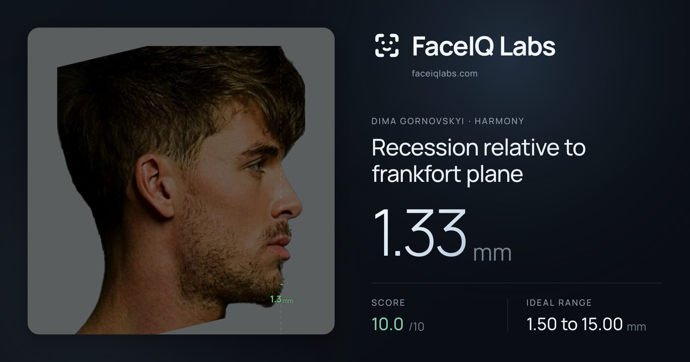 Dima Gornovskyi Recession relative to frankfort plane: 1.33mm, drawn on the photo