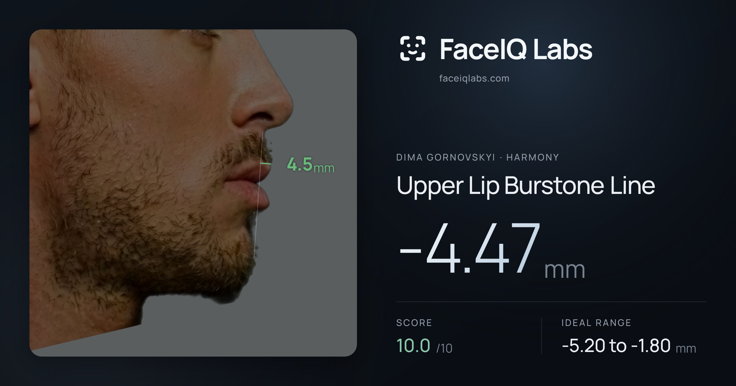 Dima Gornovskyi Upper Lip Burstone Line: -4.47mm, drawn on the photo