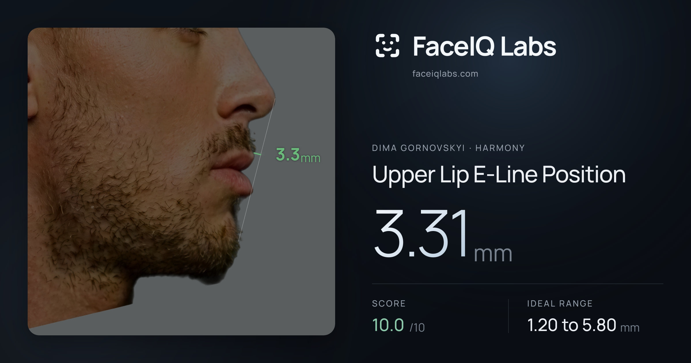 Dima Gornovskyi Upper Lip E-Line Position: 3.31mm, drawn on the photo