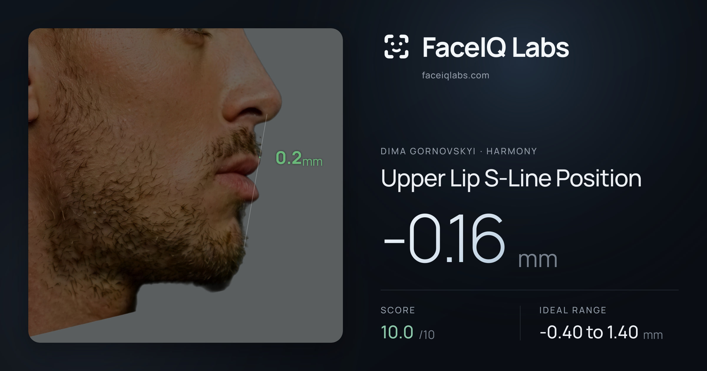 Dima Gornovskyi Upper Lip S-Line Position: -0.16mm, drawn on the photo