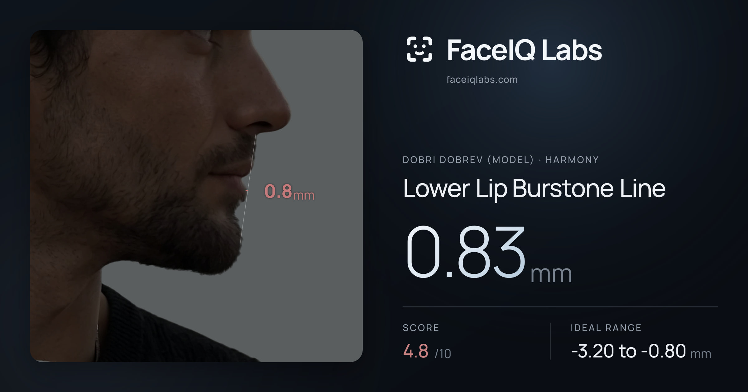 Dobri Dobrev (Model) Lower Lip Burstone Line: 0.83mm, drawn on the photo