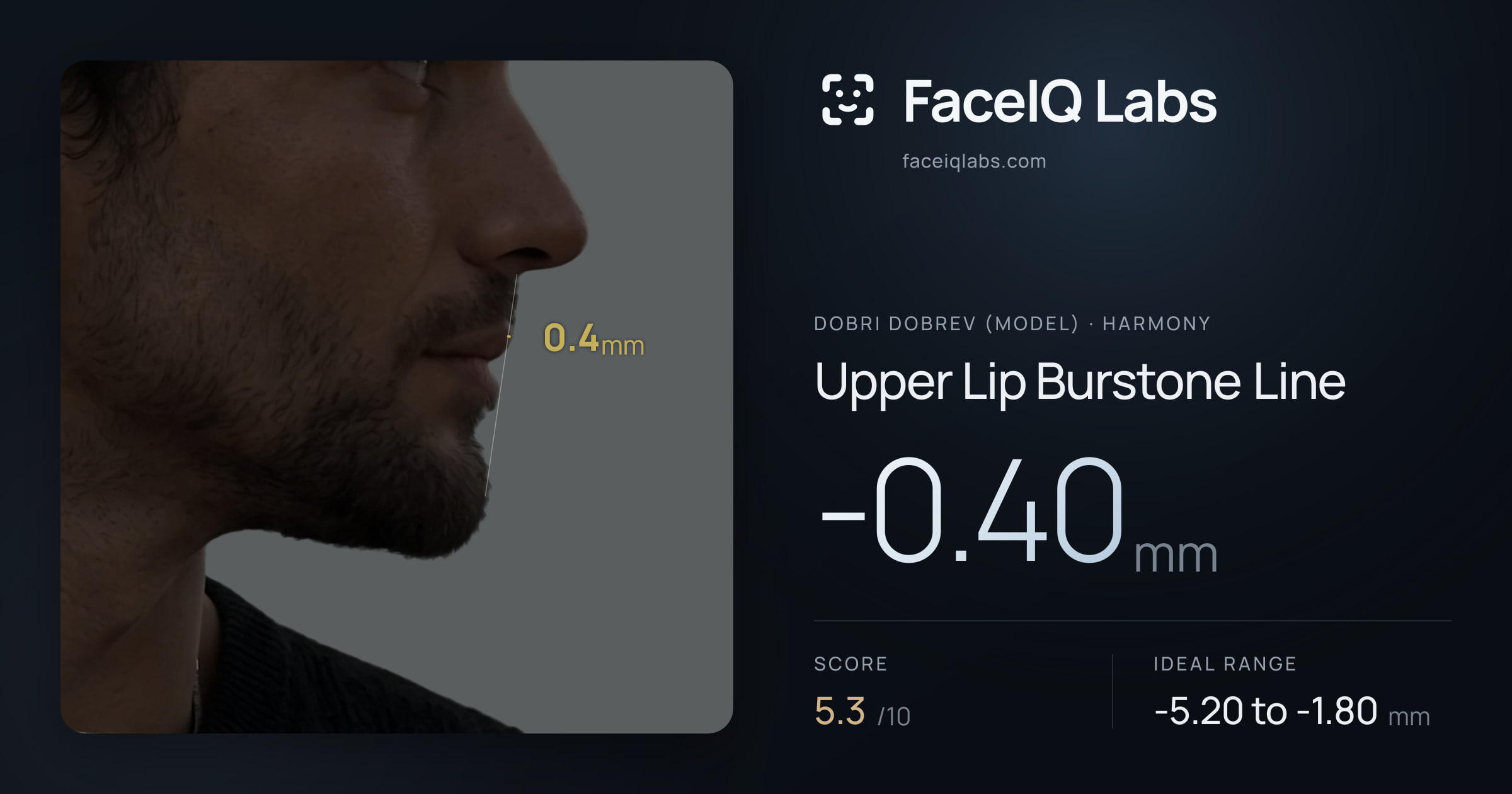 Dobri Dobrev (Model) Upper Lip Burstone Line: -0.40mm, drawn on the photo