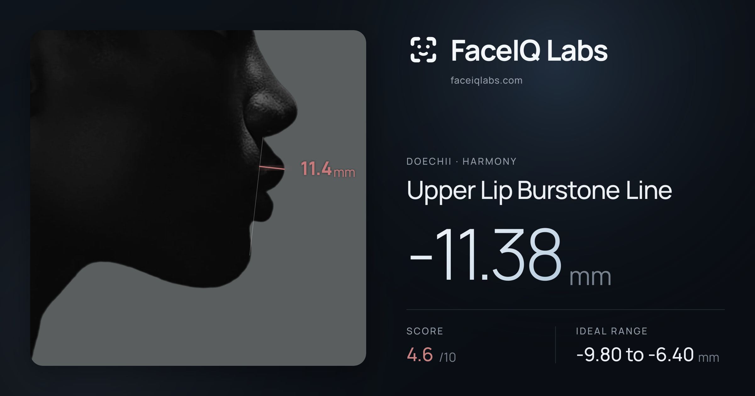 Doechii Upper Lip Burstone Line: -11.38mm, drawn on the photo