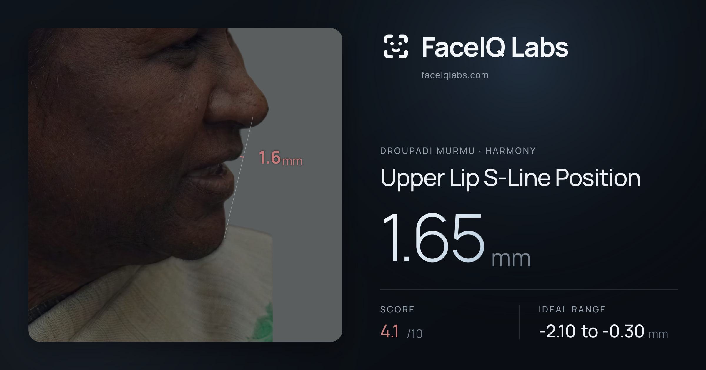 Droupadi Murmu Upper Lip S-Line Position: 1.65mm, drawn on the photo