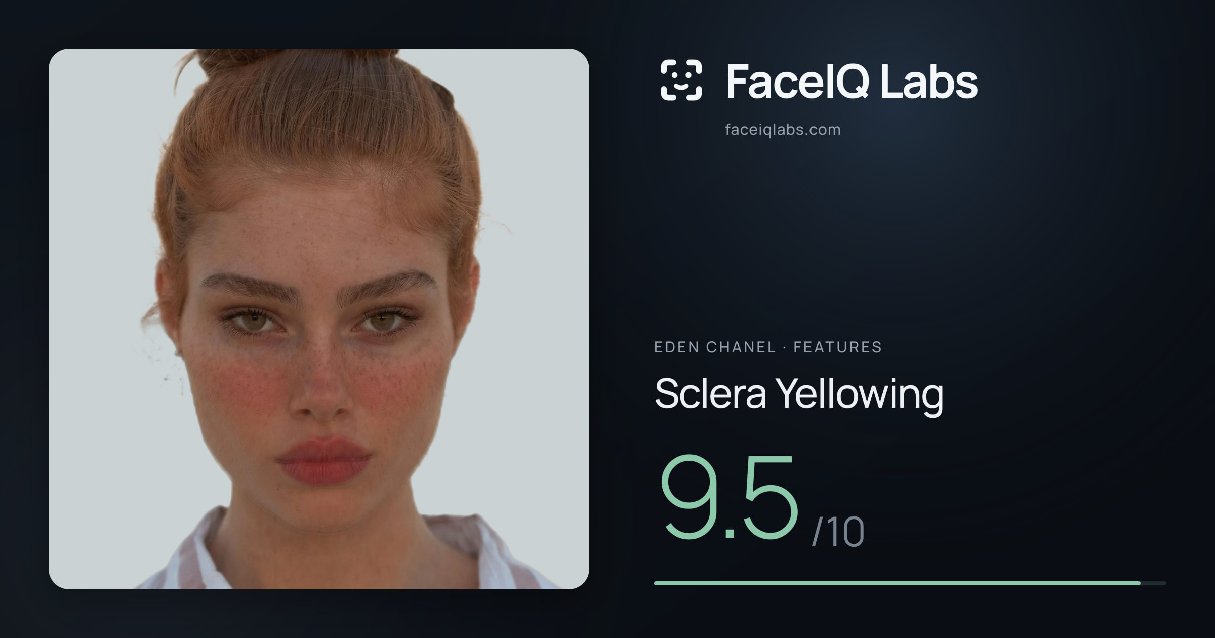 Eden Chanel Sclera Yellowing: 9.5/10, drawn on the photo