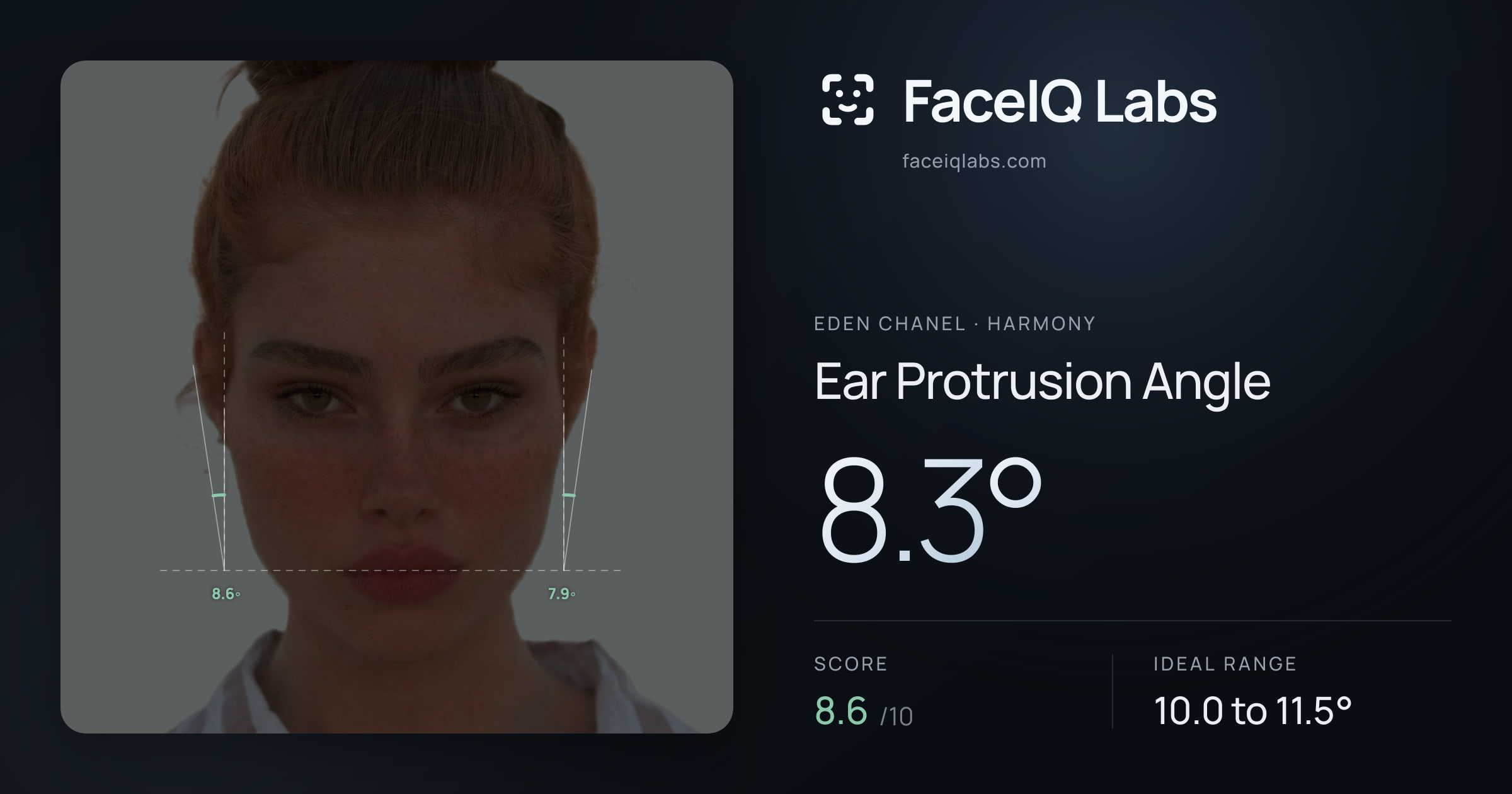 Eden Chanel Ear Protrusion Angle: 8.3°, drawn on the photo