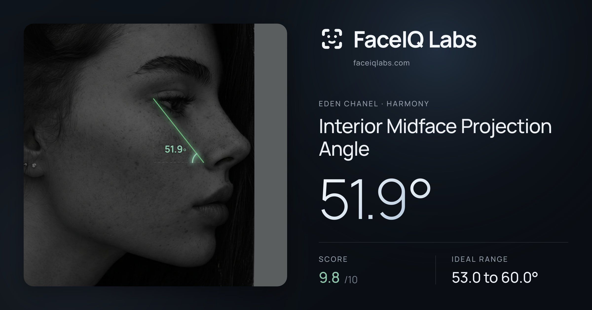 Eden Chanel Interior Midface Projection Angle: 51.9°, drawn on the photo