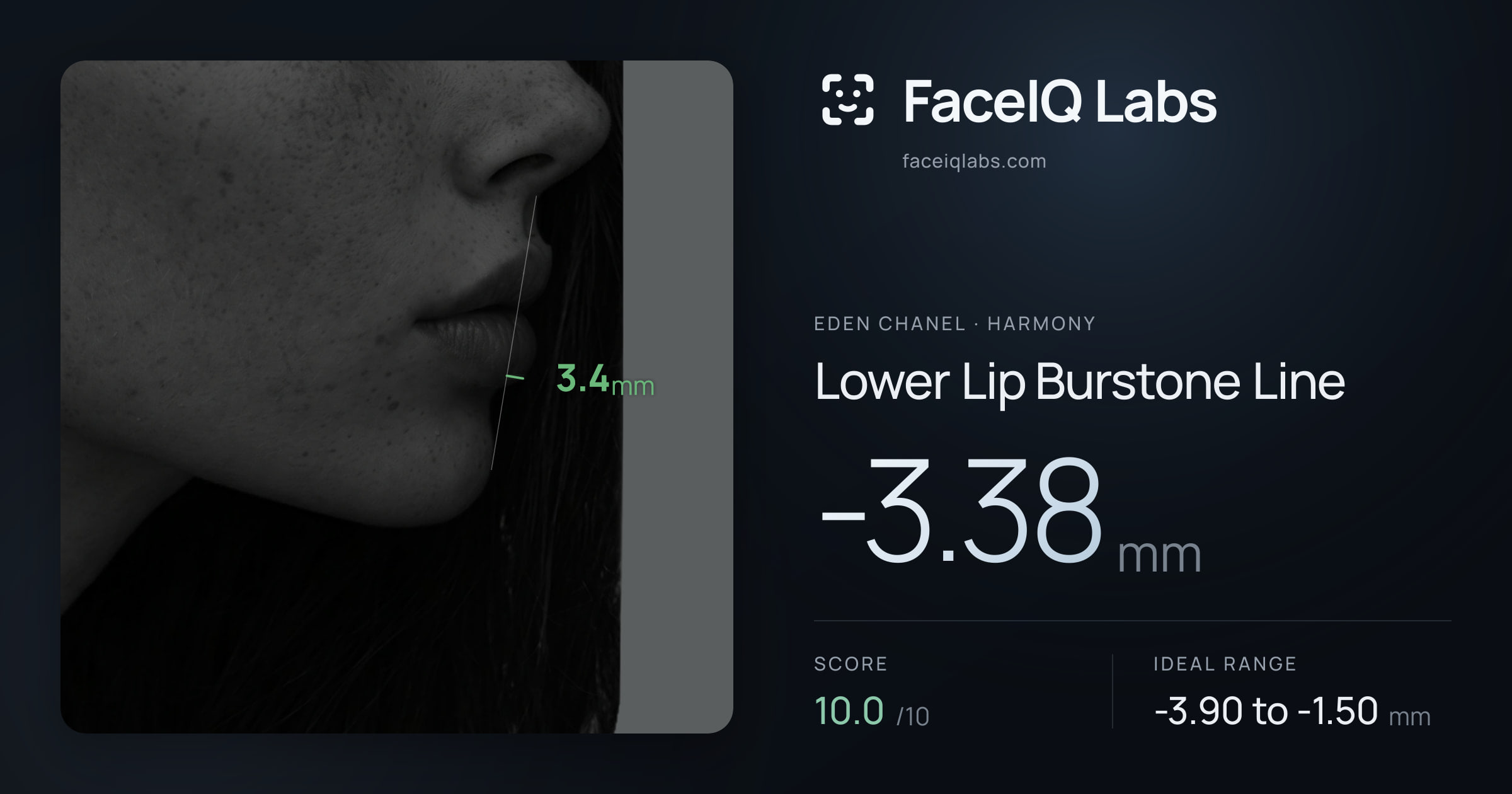 Eden Chanel Lower Lip Burstone Line: -3.38mm, drawn on the photo