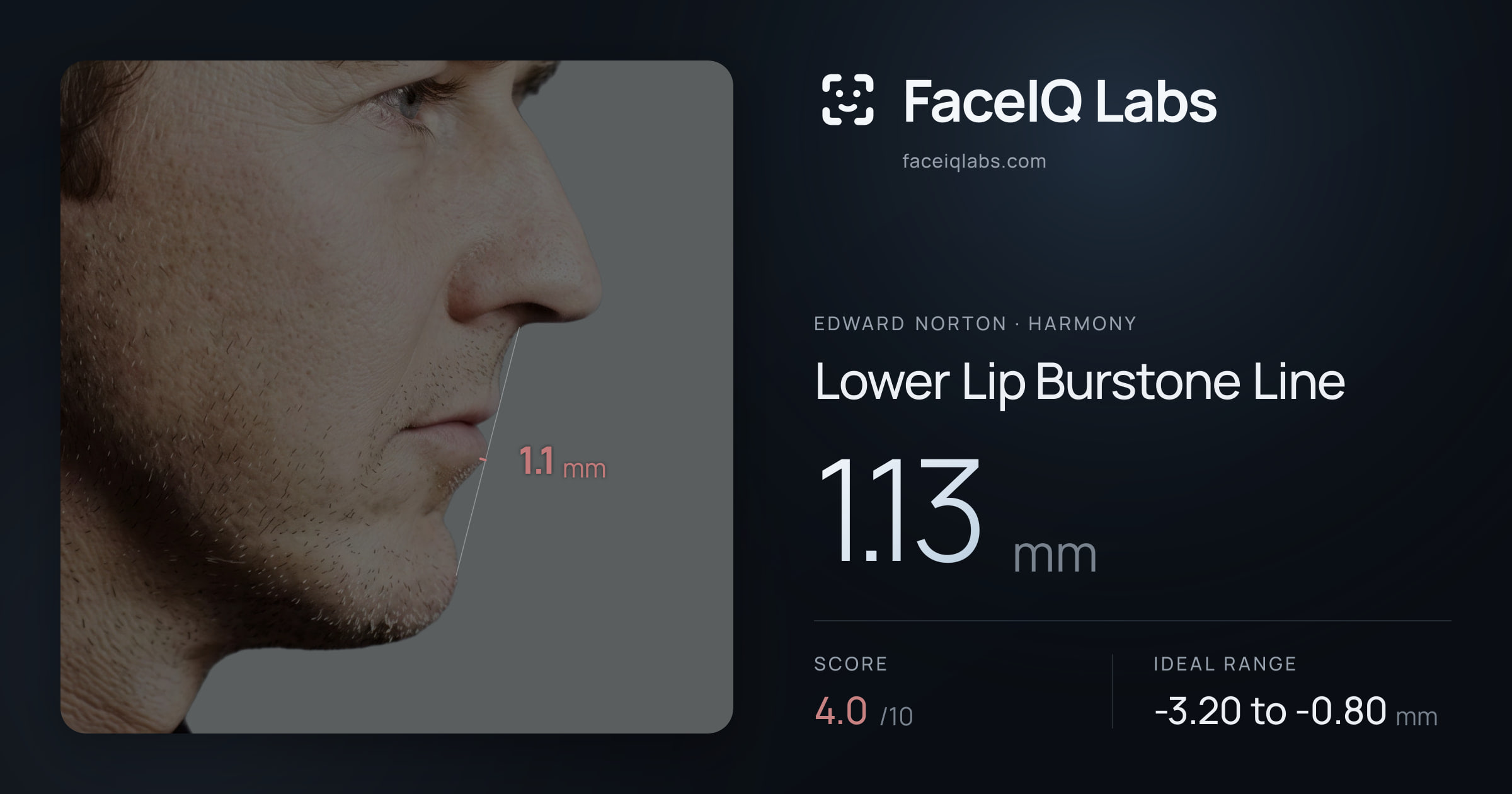 Edward Norton Lower Lip Burstone Line: 1.13mm, drawn on the photo