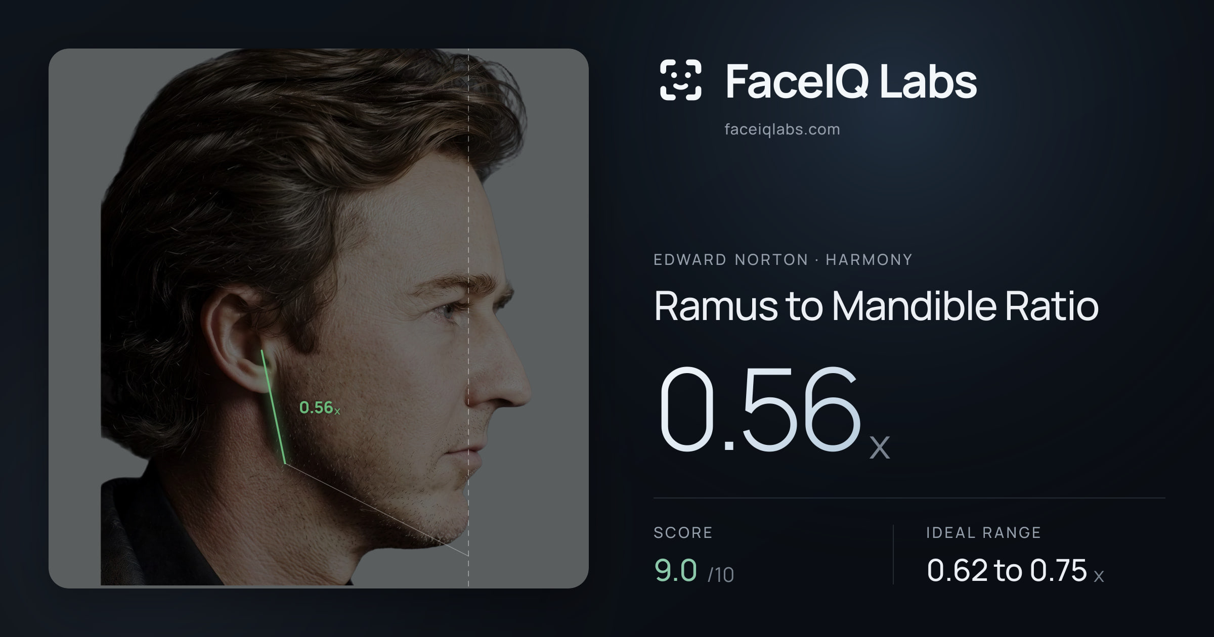 Edward Norton Ramus to Mandible Ratio: 0.56x, drawn on the photo