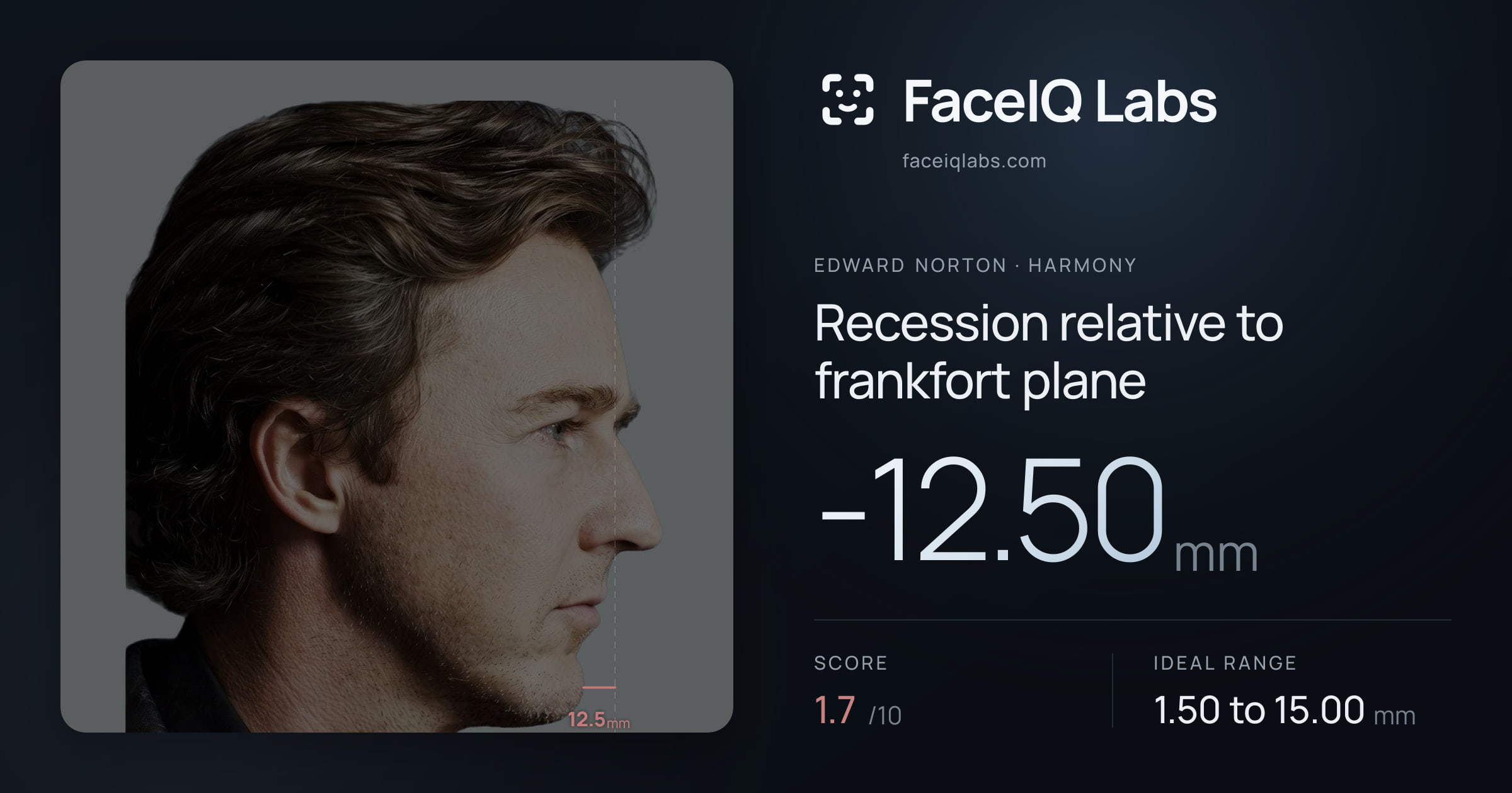 Edward Norton Recession relative to frankfort plane: -12.50mm, drawn on the photo