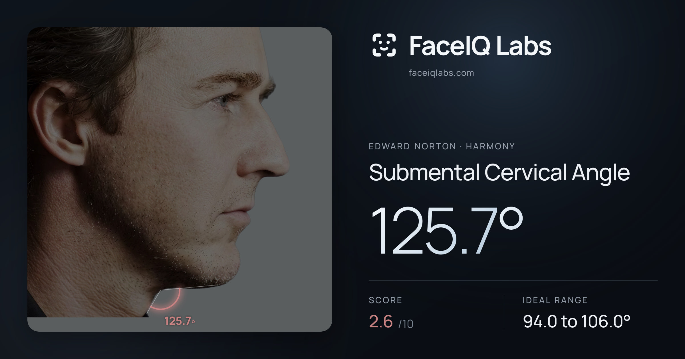 Edward Norton Submental Cervical Angle: 125.7°, drawn on the photo