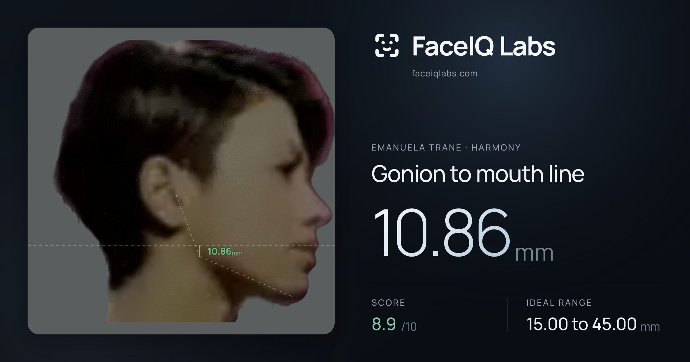 Emanuela Trane Gonion to mouth line: 10.86mm, drawn on the photo